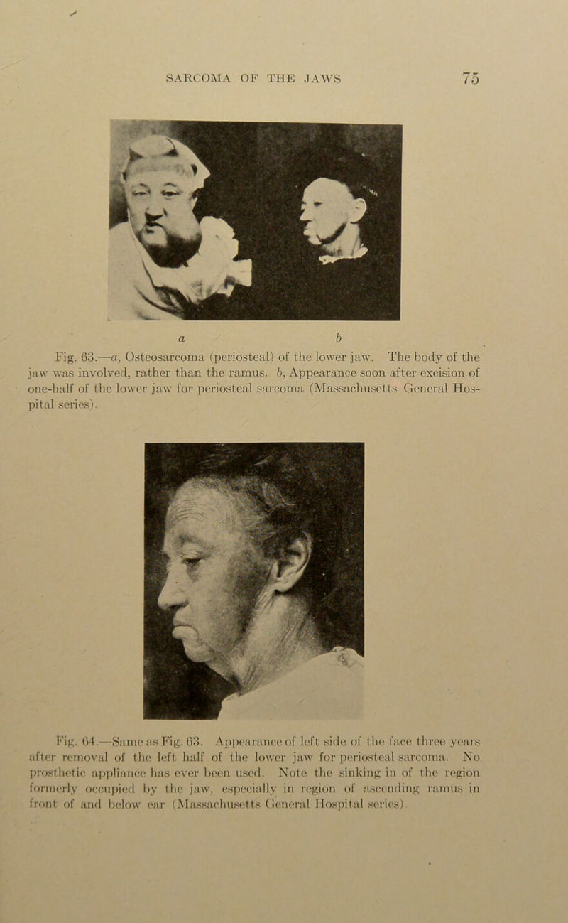a b Fig. 63.—a, Osteosarcoma (periosteal) of the lower jaw. The body of the jaw was involved, rather than the ramus, b, Appearance soon after excision of one-half of the lower jaw for periosteal sarcoma (Massachusetts General Hos- pital series). Fig. 64.—Same as Fig. 63. Appearance of left side of the face three years after removal of tin; left half of the lower jaw for periosteal sarcoma. No prosthetic appliance has ever been used. Note the sinking in of the region formerly occupied by the jaw, especially in region of ascending ramus in front of and below ear (Massachusetts General Hospital series).