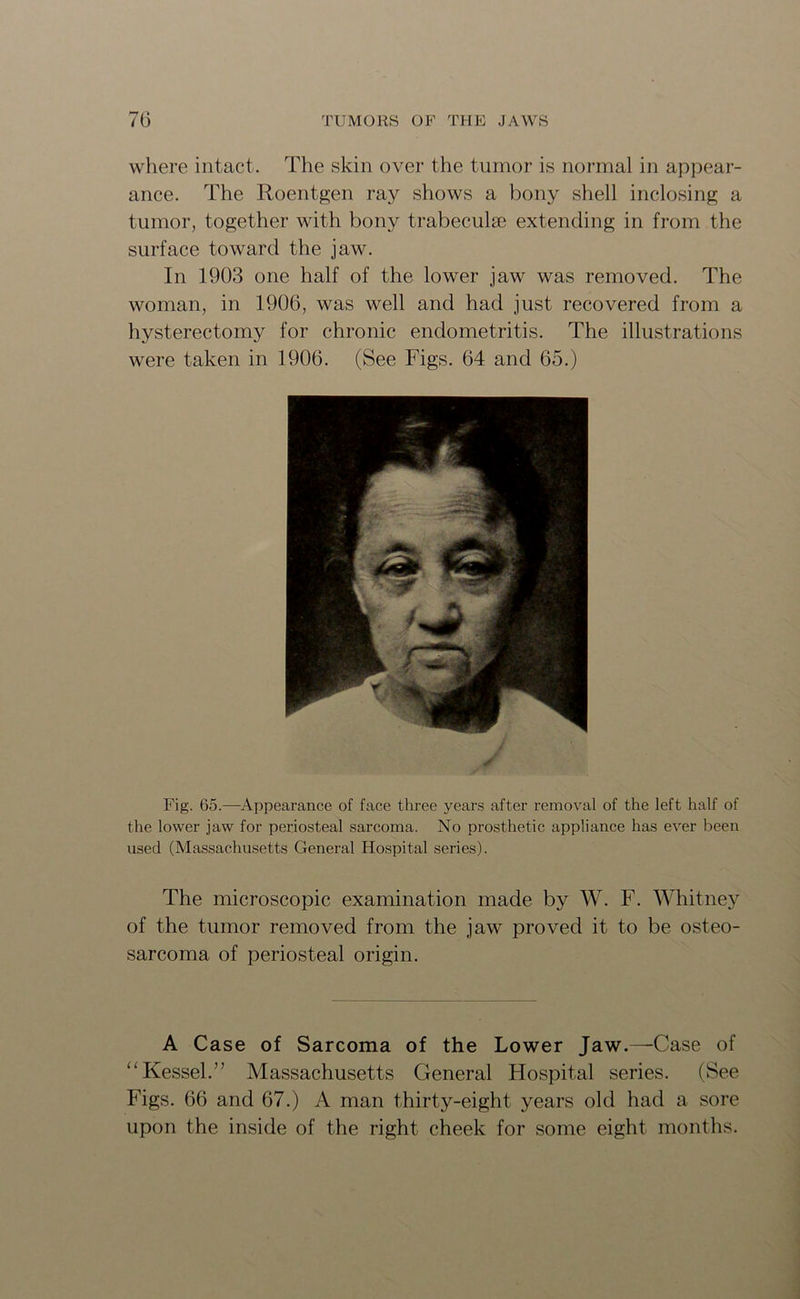 where intact. The skin over the tumor is normal in appear- ance. The Roentgen ray shows a bony shell inclosing a tumor, together with bony trabeculae extending in from the surface toward the jaw. In 1903 one half of the lower jaw was removed. The woman, in 1906, was well and had just recovered from a hysterectomy for chronic endometritis. The illustrations were taken in 1906. (See Figs. 64 and 65.) Fig. 65.—Appearance of face three years after removal of the left half of the lower jaw for periosteal sarcoma. No prosthetic appliance has ever been used (Massachusetts General Hospital series). The microscopic examination made by W. F. Whitney of the tumor removed from the jaw proved it to be osteo- sarcoma of periosteal origin. A Case of Sarcoma of the Lower Jaw.—Case of “Kessel.” Massachusetts General Hospital series. (See Figs. 66 and 67.) A man thirty-eight years old had a sore upon the inside of the right cheek for some eight months.