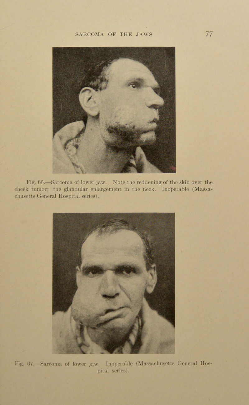 Fig. 66.—Sarcoma of lower jaw. Note the reddening of the skin over the cheek tumor; the glandular enlargement in the neck. Inoperable (Massa- chusetts General Hospital series). pital series).