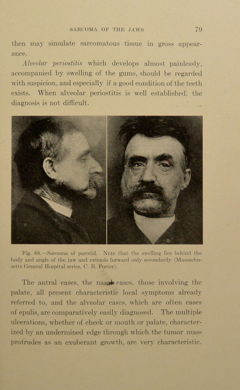 then may simulate sarcomatous tissue in gross appear- ance. Alveolar periostitis which develops almost painlessly, accompanied by swelling of the gums, should be regarded with suspicion, and especially if a good condition of the teeth exists. When alveolar periostitis is well established, the diagnosis is not difficult. Fig. 68.—Sarcoma of parotid. Note that the swelling lies behind the body and angle of the jaw and extends forward only secondarily (Massachu- setts General Hospital series, C. B. Porter). The antral cases, the nasal* cases, those involving the palate, all present characteristic local symptoms already referred to, and the alveolar cases, which are often cases of epulis, are comparatively easily diagnosed. The multiple ulcerations, whether of cheek or mouth or palate, character- ized by an undermined edge through which the tumor mass protrudes as an exuberant growth, are very characteristic.
