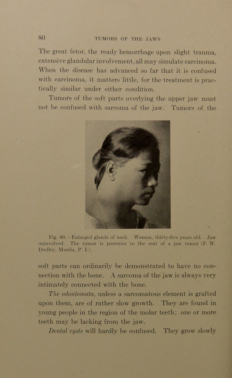 The great fetor, the ready hemorrhage upon slight trauma, extensive glandular involvement, all may simulate carcinoma. Y\ hen the disease has advanced so far that it is confused with carcinoma, it matters little, for the treatment is prac- tically similar under either condition. Tumors of the soft parts overlying the upper jaw must not be confused with sarcoma of the jaw. Tumors of the Fig. 69.—Enlarged glands of neck. Woman, thirty-five years old. Jaw uninvolved. The tumor is posterior to the seat of a jaw tumor (F. W. Dudley, Manila, P. I.). soft parts can ordinarily be demonstrated to have no con- nection with the bone. A sarcoma of the jaw is always very intimately connected with the bone. The odontomata, unless a sarcomatous element is grafted upon them, are of rather slow growth. They are found in young people in the region of the molar teeth; one or more teeth may be lacking from the jaw. Dental cysts will hardly be confused. They grow slowly