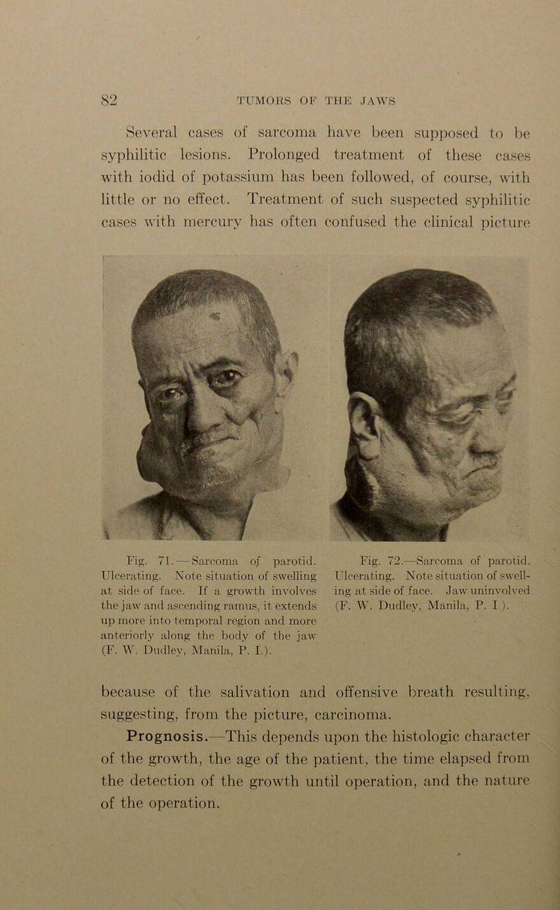 Several cases of sarcoma have been supposed to be syphilitic lesions. Prolonged treatment of these cases with iodid of potassium has been followed, of course, with little or no effect. Treatment of such suspected syphilitic cases with mercury has often confused the clinical picture Fig. 71. — Sarcoma of parotid. Ulcerating. Note situation of swelling at side of face. If a growth involves the jaw and ascending ramus, it extends up more into temporal region and more anteriorly along the body of the jaw (F. W. Dudley, Manila, P. I.). Fig. 72.—Sarcoma of parotid. Ulcerating. Note situation of swell- ing at side of face. Jaw uninvolved (F. W. Dudley, Manila, P. I ). because of the salivation and offensive breath resulting, suggesting, from the picture, carcinoma. Prognosis.—This depends upon the histologic character of the growth, the age of the patient, the time elapsed from the detection of the growth until operation, and the nature of the operation.