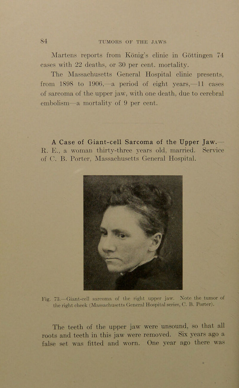 Martens reports from Konig’s clinic in Gottingen 74 cases with 22 deaths, or 30 per cent, mortality. The Massachusetts General Hospital clinic presents, from 1898 to 1906,—a period of eight years,—11 cases of sarcoma of the upper jaw, with one death, due to cerebral embolism—a mortality of 9 per cent. A Case of Giant-cell Sarcoma of the Upper Jaw.- R. E., a woman thirty-three years old, married. Service of C. B. Porter, Massachusetts General Hospital. Fig. 73.—Giant-cell sarcoma of the right upper jaw. Note the tumor of the right cheek (Massachusetts General Hospital series, C. B. Porter). The teeth of the upper jaw were unsound, so that all roots and teeth in this jaw were removed. Six years ago a false set was fitted and worn. One year ago there was