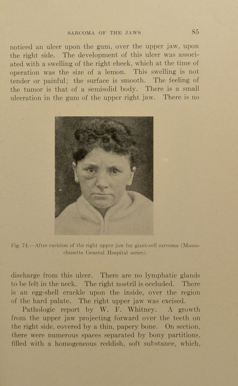 noticed an ulcer upon the gum, over the upper jaw, upon the right side. The development of this ulcer was associ- ated with a swelling of the right cheek, which at the time of operation was the size of a lemon. This swelling is not tender or painful; the surface is smooth. The feeling of the tumor is that of a semisolid body. There is a small ulceration in the gum of the upper right jaw. There is no Fig. <4.—After excision of the right upper jaw for giant-cell sarcoma (Massa- chusetts General Hospital series). discharge from this ulcer. There are no lymphatic glands to be felt in the neck. The right nostril is occluded. There is an egg-shell crackle upon the inside, over the region of the hard palate. The right upper jaw was excised. Pathologic report by W. F. Whitney. A growth from the upper jaw projecting forward over the teeth on the right side, covered by a thin, papery bone. On section, there were numerous spaces separated by bony partitions, filled with a homogeneous reddish, soft substance, which,
