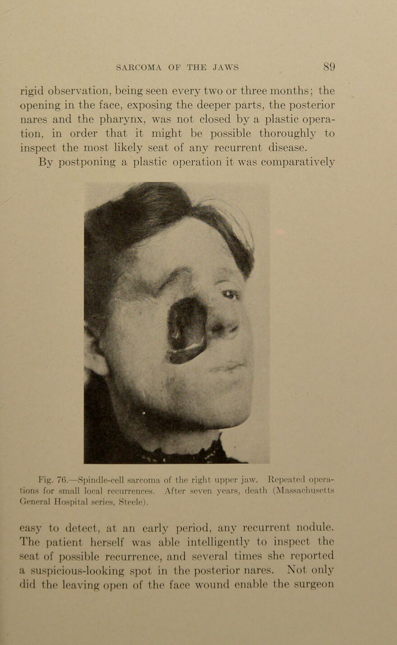 rigid observation, being seen every two or three months; the opening in the face, exposing the deeper parts, the posterior nares and the pharynx, was not closed by a plastic opera- tion, in order that it might be possible thoroughly to inspect the most likely seat of any recurrent disease. By postponing a plastic operation it was comparatively Fig. 70.—Spindle-cell sarcoma of the right upper jaw. Repeated opera- tions for small local recurrences. After seven years, death (Massachusetts General Hospital series, Steele). easy to detect, at an early period, any recurrent nodule. The patient herself was able intelligently to inspect the seat of possible recurrence, and several times she reported a suspicious-looking spot in the posterior nares. Not only did the leaving open of the face wound enable I he surgeon