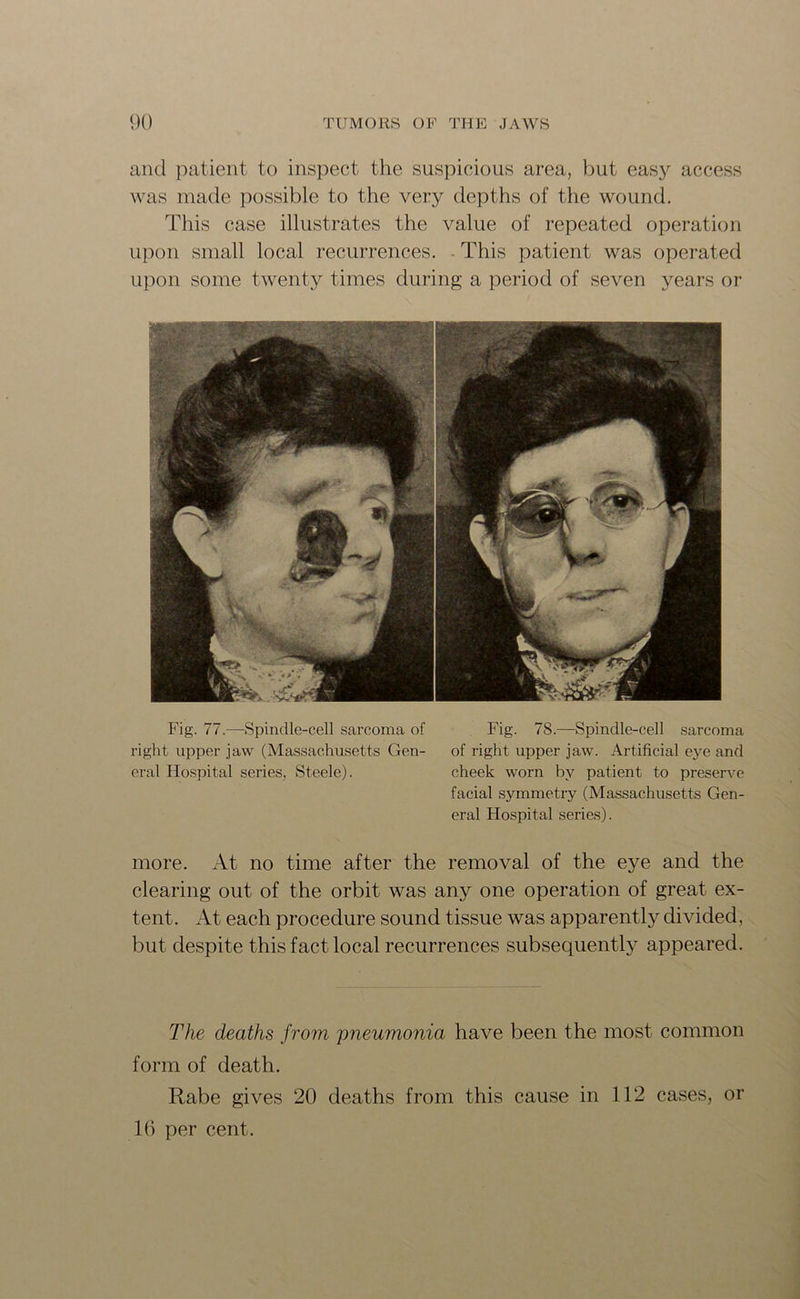 and patient to inspect the suspicious area, but easy access was made possible to the very depths of the wound. This case illustrates the value of repeated operation upon small local recurrences. This patient was operated upon some twenty times during a period of seven years or Fig. 77.—Spinclle-cell sarcoma of Fig. 78.—Spindle-cell sarcoma right upper jaw (Massachusetts Gen- of right upper jaw. Artificial eye and eral Hospital series, Steele). cheek worn by patient to preserve facial symmetry (Massachusetts Gen- eral Hospital series). more. At no time after the removal of the eye and the clearing out of the orbit was any one operation of great ex- tent. At each procedure sound tissue was apparentl}r divided, but despite this fact local recurrences subsequently appeared. The deaths from 'pneumonia have been the most common form of death. Rabe gives 20 deaths from this cause in 112 cases, or 16 per cent.