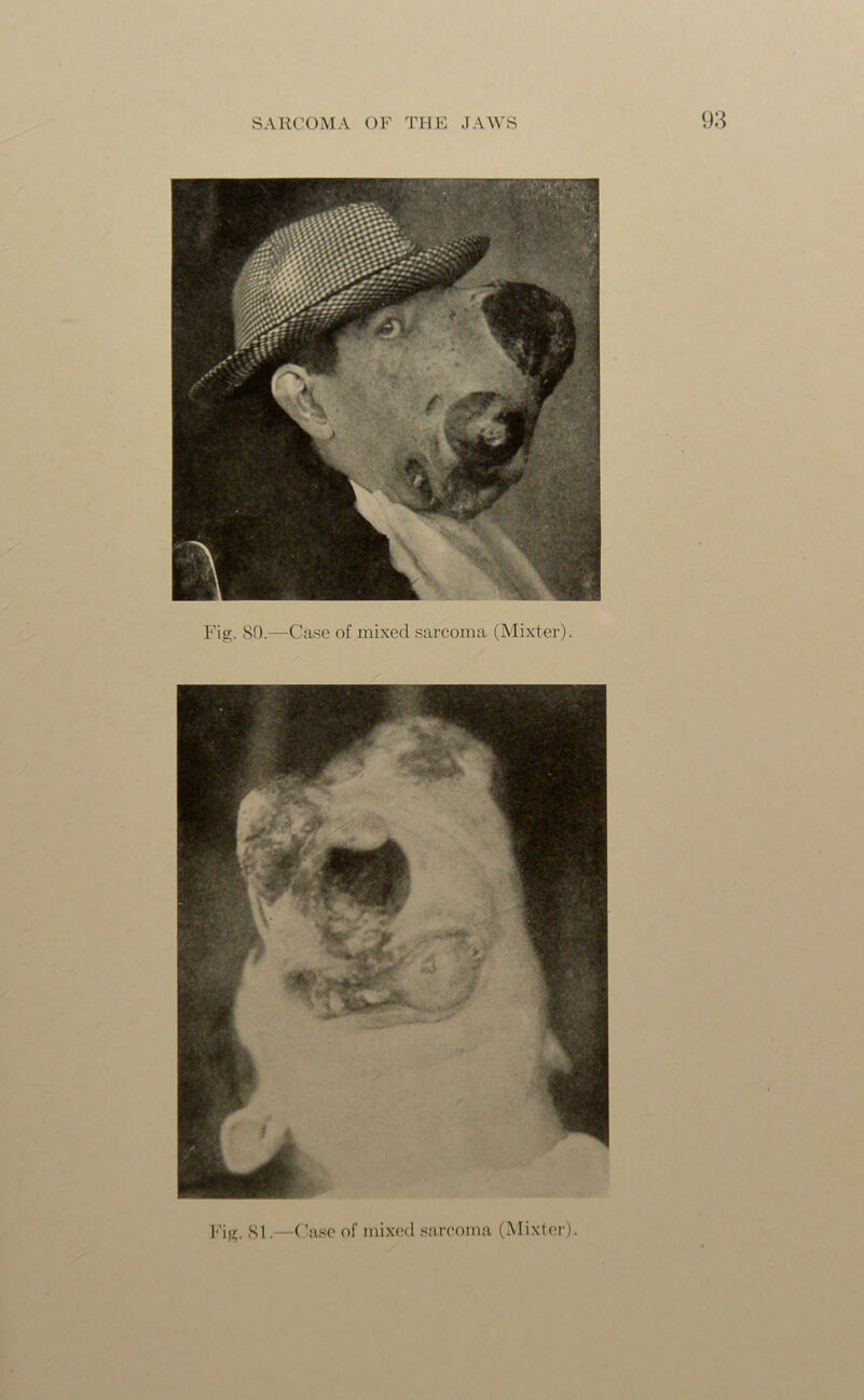 Fig. SO.—Case of mixed sarcoma (Mixter). Fig. 81.—Case of mixed sarcoma (Mixter).