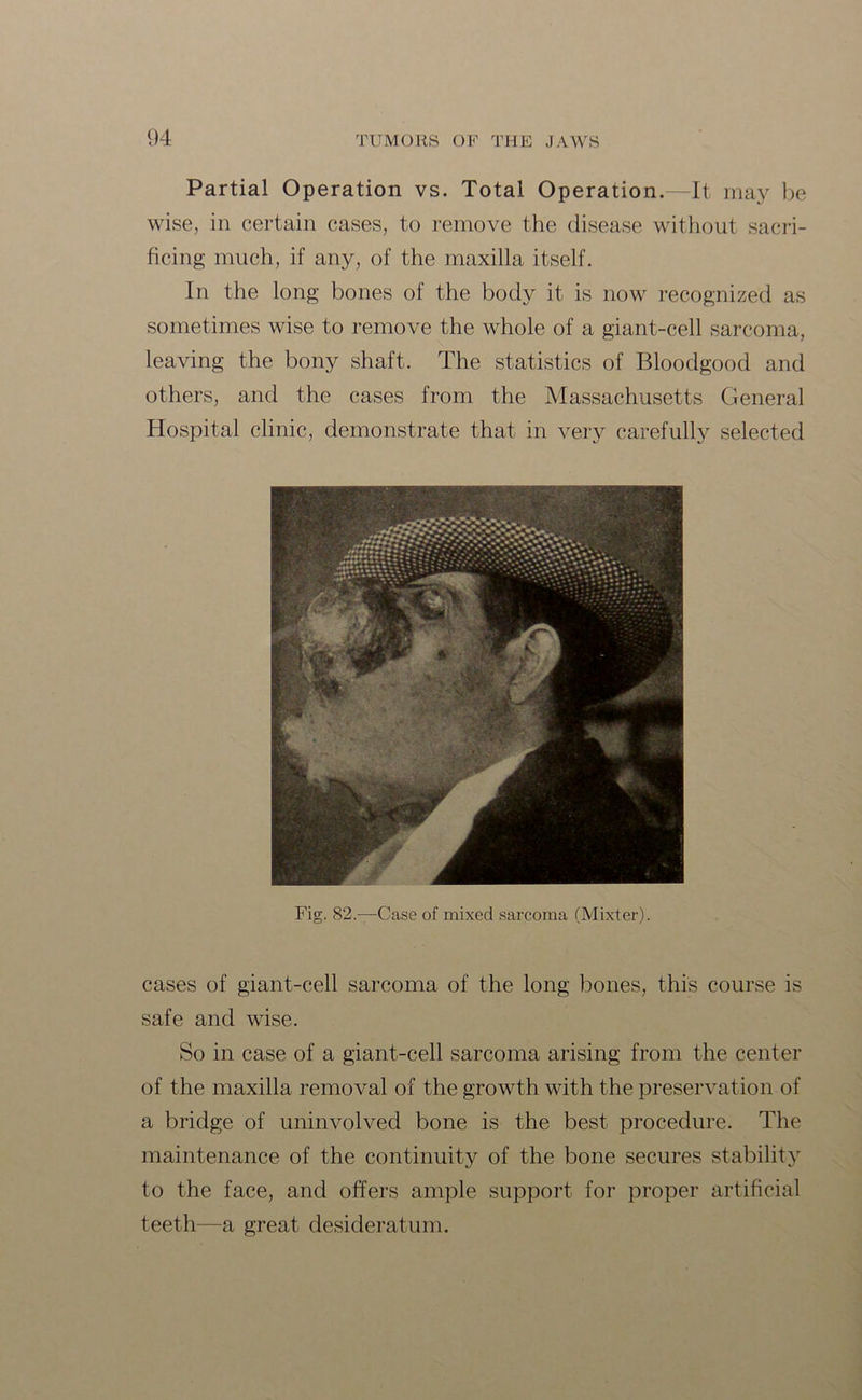Partial Operation vs. Total Operation.—It may be wise, in certain cases, to remove the disease without sacri- ficing much, if any, of the maxilla itself. In the long bones of the body it is now recognized as sometimes wise to remove the whole of a giant-cell sarcoma, leaving the bony shaft. The statistics of Bloodgood and others, and the cases from the Massachusetts General Hospital clinic, demonstrate that in very carefully selected Fig. 82.—Case of mixed sarcoma (Mixter). cases of giant-cell sarcoma of the long bones, this course is safe and wise. So in case of a giant-cell sarcoma arising from the center of the maxilla removal of the growth with the preservation of a bridge of uninvolved bone is the best procedure. The maintenance of the continuity of the bone secures stability to the face, and offers ample support for proper artificial teeth—a great desideratum.