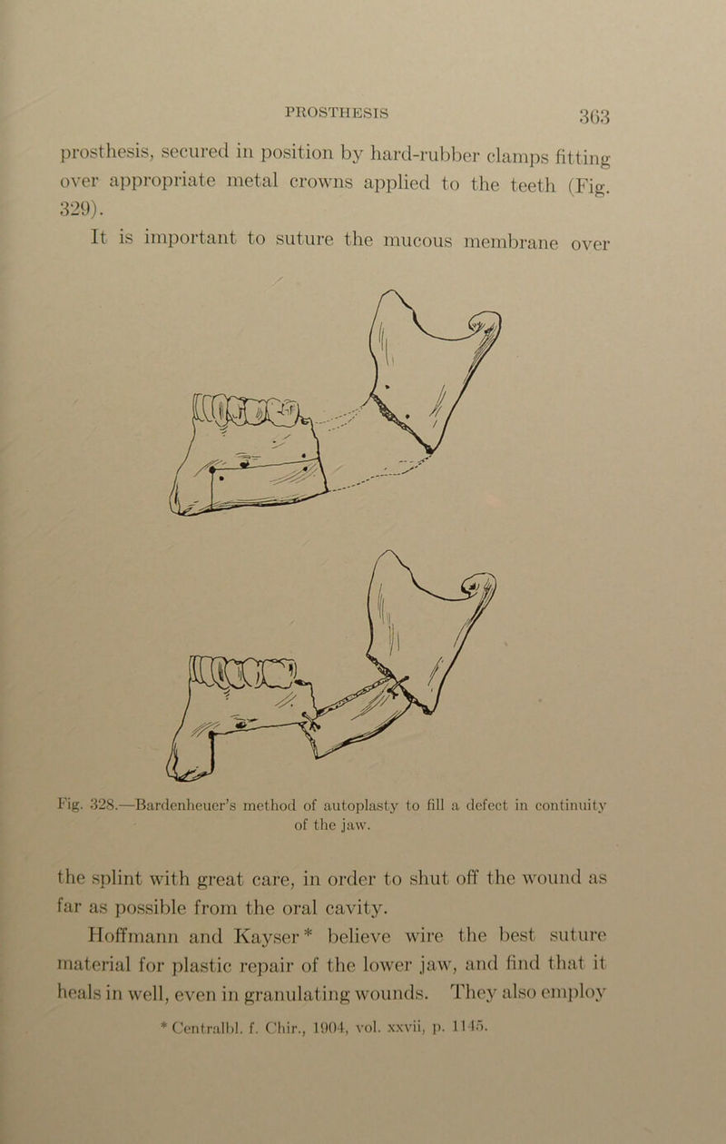 prosthesis, secured in position by hard-rubber clamps fitting- over appropriate metal crowns applied to the teeth (Fig. It is important to suture the mucous membrane over Fig. 328.—Bardenheuer’s method of autoplasty to fill a defect in continuity of the jaw. the splint with great care, in order to shut off the wound as far as possible from the oral cavity. Hoffmann and Kayser * believe wire the best suture material for plastic repair of the lower jaw, and find that it heals in well, even in granulating wounds. They also employ 329). * Central hi. f. Chir., 1904, vol. xxvii, p. IMa.