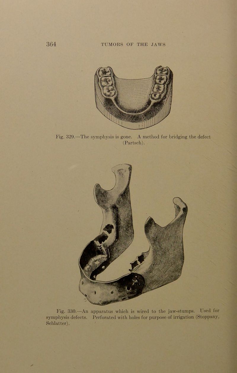 Fig. 329.—The symphysis is gone. A method for bridging the defect (Partsch). Fig. 330.—An apparatus which is wired to the jaw-stumps. Used for symphysis defects. Perforated with holes for purpose of irrigation (Stoppany, Schlatter).