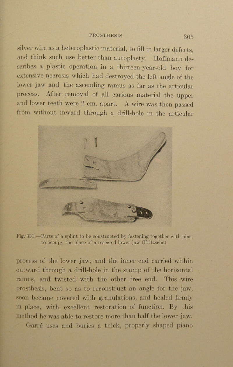 3G5 silver wire as a heteroplastic material, to fill in larger defects, and think such use better than autoplasty. Hoffmann de- scribes a plastic operation in a thirteen-year-old boy for extensive necrosis which had destroyed the left angle of the lower jaw and the ascending ramus as far as the articular process. After removal of all carious material the upper and lower teeth were 2 cm. apart. A wire was then passed from without inward through a drill-hole in the articular Fig. 331.—Parts of a splint to be constructed by fastening together with pins, to occupy the place of a resected lower jaw (Fritzsche). process of the lower jaw, and the inner end carried within outward through a drill-hole in the stump of the horizontal ramus, and twisted with the other free end. This wire prosthesis, bent so as to reconstruct an angle for the jaw, soon became covered with granulations, and healed firmly in place, with excellent restoration of function. By this method he was able to restore more than half the lower jaw. Garre uses and buries a thick, properly shaped piano