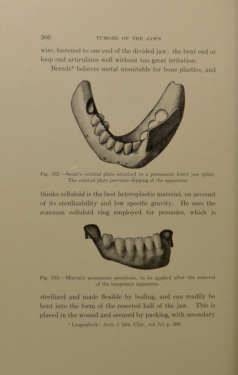 wire, fastened to one end of the divided jaw; the bent end or loop end articulates well without too great irritation. Berndt* believes metal unsuitable for bone plastics, arid Fig. 332.—Sauer’s vertical plate attached to a permanent lower jaw splint. The vertical plate prevents slipping of the apparatus. thinks celluloid is the best heteroplastic material, on account of its sterilizability and low specific gravity. He uses the common celluloid ring employed for pessaries, which is Fig. 333.—Martin’s permanent prosthesis, to be applied after the removal of the temporary apparatus. sterilized and made flexible by boiling, and can readily be bent into the form of the resected half of the jaw. This is placed in the wound and secured by packing, with secondary * Langenbeck: Arch. f. klin. Chir., vol. Ivi, p. 208.