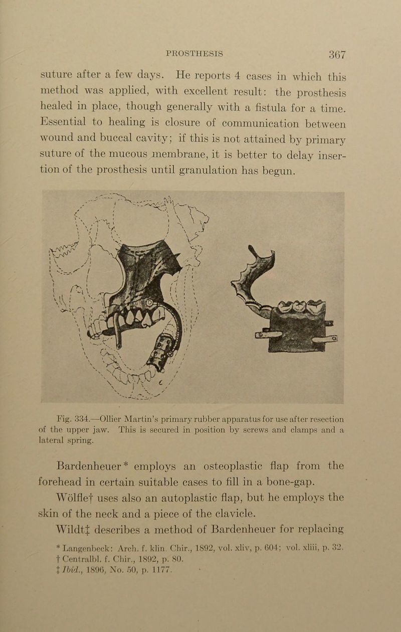 suture after a few days. He reports 4 cases in which this method was applied, with excellent result: the prosthesis healed in place, though generally with a fistula for a time. Essential to healing is closure of communication between wound and buccal cavity; if this is not attained by primary suture of the mucous membrane, it is better to delay inser- tion of the prosthesis until granulation has begun. Fig. 334.—Ollier Martin’s primary rubber apparatus for use after resection of the upper jaw. This is secured in position by screws and clamps and a lateral spring. Bardenheuer * employs an osteoplastic flap from the forehead in certain suitable cases to fill in a bone-gap. Wolflef uses also an autoplastic flap, but he employs the skin of the neck and a piece of the clavicle. WildtJ describes a method of Bardenheuer for replacing * Langcnbeck: Arch. f. klin. Chir., 1892, vol. xliv, p. 604; vol. xliii, p. 32. t Centralbl. f. Chir., 1892, p. 80. X Ibid., 1896, No. 50, p. 1177.