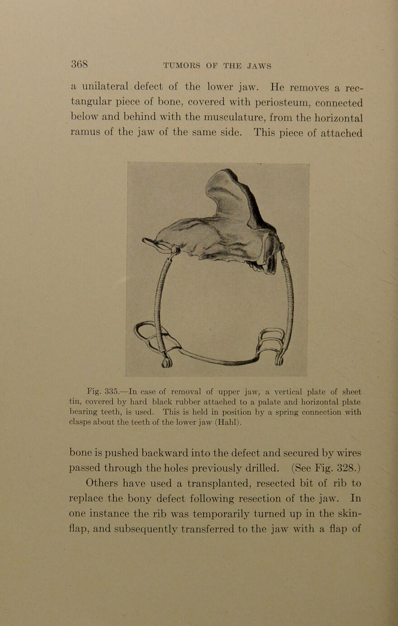 a unilateral defect of the lower jaw. He removes a rec- tangular piece of bone, covered with periosteum, connected below and behind with the musculature, from the horizontal ramus of the jaw of the same side. This piece of attached Fig. 335.—In case of removal of upper jaw, a vertical plate of sheet tin, covered by hard black rubber attached to a palate and horizontal plate bearing teeth, is used. This is held in position by a spring connection with clasps about the teeth of the lower jaw (Halil). bone is pushed backward into the defect and secured by wires passed through the holes previously drilled. (See Fig. 328.) Others have used a transplanted, resected bit of rib to replace the bony defect following resection of the jaw. In one instance the rib was temporarily turned up in the skin- flap, and subsequently transferred to the jaw with a flap of