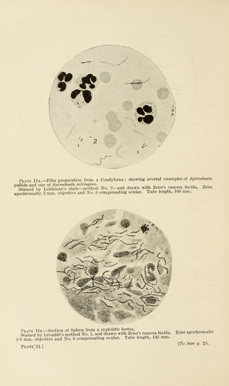 Plate IIa.—Film preparation from a Condyloma ; showing several examples of Spirocliaeta vallida and one oi Spirochaeta refritigetis. i j fj ■ „ Stained by Leishman’s stain—method No. 2—and drawn with Zeiss s camera lucida. Zeiss apochromatic 2 mm. objective and No. C compensating ocular. lube length, 160 mm. Salned^by LeStl’s method NS^randd^S^^^ with Zeiss’s camera lucida. Zeiss apochromatic 1-5 mm. objective and No. 6 compensating ocular. Tube length, 14o mm. PliATE'II.]