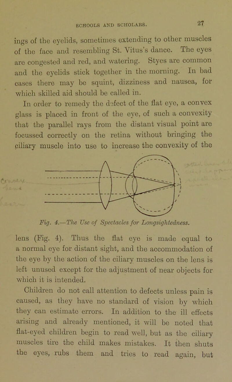 ings of the eyelids, sometimes extending to other muscles of the face and resembling St. Vitus’s dance. The eyes are congested and red, and watering. Styes are common and the eyelids stick together in the morning. In bad cases there may be squint, dizziness and nausea, for which skilled aid should be called in. In order to remedy the defect of the flat eye, a convex glass is placed in front of the eye, of such a convexity that the parallel rays from the distant visual point are focussed correctly on the retina without bringing the ciliary muscle into use to increase the convexity of the Fig. 4.—The Use of Spectacles for Longsightedness. lens (Fig. 4). Thus the flat eye is made equal to a normal eye for distant sight, and the accommodation of the eye by the action of the ciliary muscles on the lens is left unused except for the adjustment of near objects for which it is intended. Children do not call attention to defects unless pain is caused, as they have no standard of vision by which they can estimate errors. In addition to the ill effects arising and already mentioned, it will be noted that flat-eyed children begin to read well, but as the ciliary muscles tire the child makes mistakes. It then shuts the eyes, rubs them and tries to read again, but