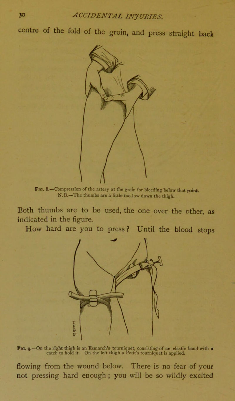 centre of the fold of the groin, and press straight back Fig. 8.—Compression of the artery at the groin for bleeding below that point. N.B.—The thumbs are a little too low down the thigh. Both thumbs are to be used, the one over the other, as indicated in the figure. How hard are you to press ? Until the blood stops Kig. 9.—On the right thigh is an Esmarch’s toumiauet, consisting of an elastic band with a catch to hold it. On the left thigh a Petit’s tourniquet is applied. flowing from the wound below. There is no fear of your not pressing hard enough ; you will be so wildly excited