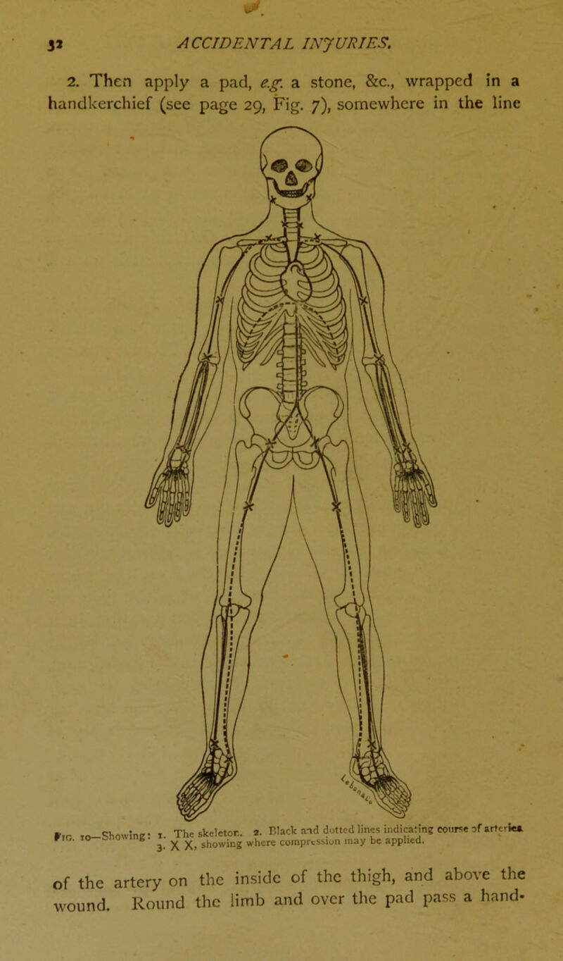 2. Then apply a pad, e.g. a stone, &c., wrapped in a handkerchief (see page 29, Fig. 7), somewhere in the line of the artery on the inside of the thigh, and above the wound. Round the limb and over the pad pass a hand-