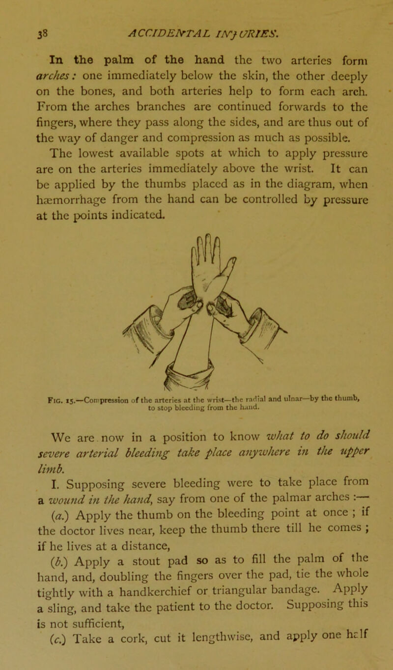 In the palm of the hand the two arteries form arches: one immediately below the skin, the other deeply on the bones, and both arteries help to form each arch. From the arches branches are continued forwards to the fingers, where they pass along the sides, and are thus out of the way of danger and compression as much as possible. The lowest available spots at which to apply pressure are on the arteries immediately above the wrist. It can be applied by the thumbs placed as in the diagram, when haemorrhage from the hand can be controlled by pressure at the points indicated. Fig. 15.—Compression of the arteries at the wrist—the radial and ulnar by the thumb, to stop bleeding from the hand. We are now in a position to know what to do should severe arterial bleeding take place anywhere in the upper limb. I. Supposing severe bleeding were to take place from a wound in the hand, say from one of the palmar arches : (a.) Apply the thumb on the bleeding point at once ; if the doctor lives near, keep the thumb there till he comes ; if he lives at a distance, (b.) Apply a stout pad so as to fill the palm of the hand, and, doubling the fingers over the pad, tie the whole tightly with a handkerchief or triangular bandage. Apply a sling, and take the patient to the doctor. Supposing this is not sufficient, (c.) Take a cork, cut it lengthwise, and apply one he If