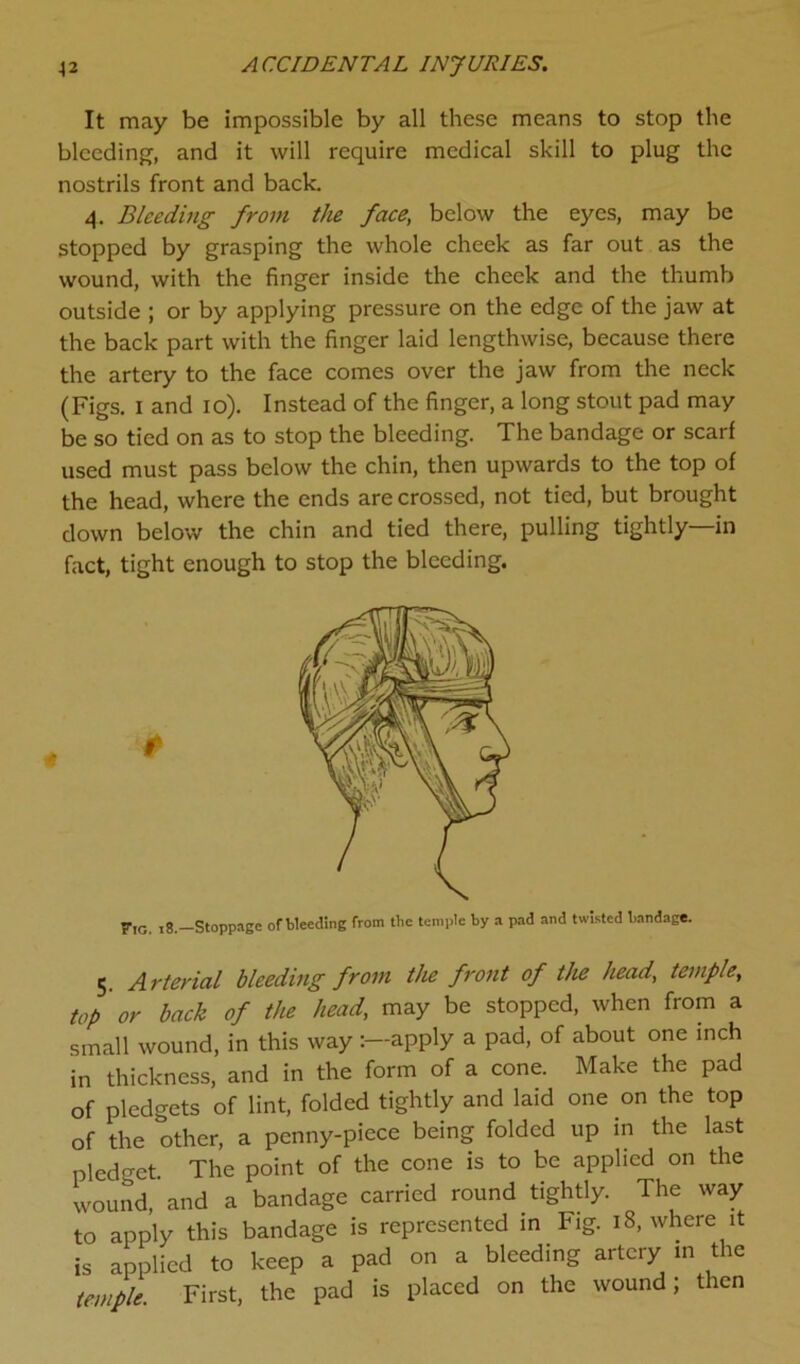 It may be impossible by all these means to stop the bleeding, and it will require medical skill to plug the nostrils front and back. 4. Bleeding from the face, below the eyes, may be stopped by grasping the whole cheek as far out as the wound, with the finger inside the check and the thumb outside ; or by applying pressure on the edge of the jaw at the back part with the finger laid lengthwise, because there the artery to the face comes over the jaw from the neck (Figs. 1 and 10). Instead of the finger, a long stout pad may be so tied on as to stop the bleeding. The bandage or scarf used must pass below the chin, then upwards to the top of the head, where the ends are crossed, not tied, but brought down below the chin and tied there, pulling tightly—in fact, tight enough to stop the bleeding. Fig. 18. Stoppage of Weeding from the temple by a pad and twisted bandage. 5. Arterial bleeding from the front of the head, temple, top or back of the head, may be stopped, when from a small wound, in this way :—apply a pad, of about one inch in thickness, and in the form of a cone. Make the pad of pledgets of lint, folded tightly and laid one on the top of the other, a penny-piece being folded up in the last pledget The point of the cone is to be applied on the wound, and a bandage carried round tightly. The way to apply this bandage is represented in Fig. 18, where it is applied to keep a pad on a bleeding artery m the temple. First, the pad is placed on the wound; then