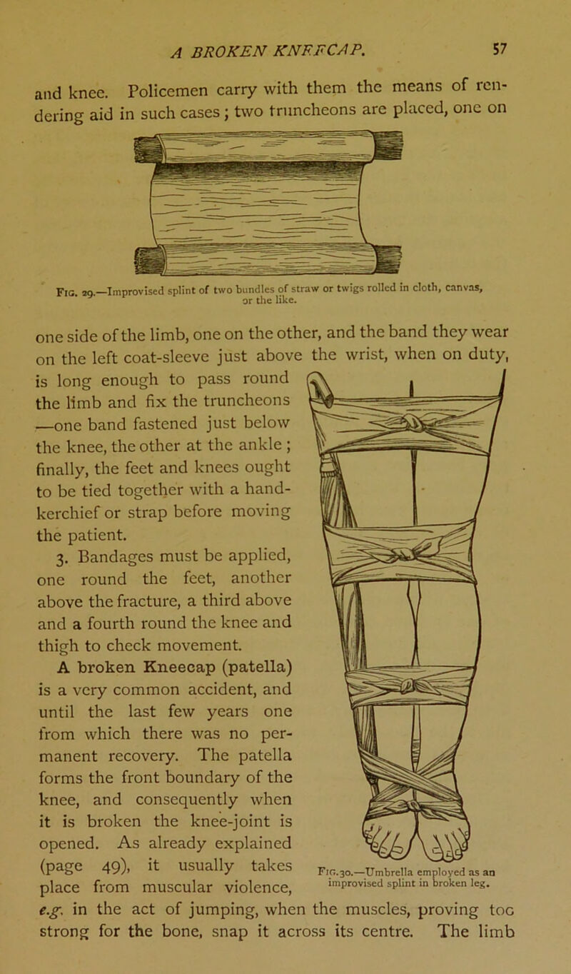 and knee. Policemen carry with them the means of ren- dering aid in such cases; two truncheons are placed, one on Fig 20 —Improvised splint of two bundles of straw or twigs rolled in cloth, canvas, or the like. one side of the limb, one on the other, and the band they wear on the left coat-sleeve just above the wrist, when on duty, is long enough to pass round the limb and fix the truncheons —one band fastened just below the knee, the other at the ankle ; finally, the feet and knees ought to be tied together with a hand- kerchief or strap before moving the patient. 3. Bandages must be applied, one round the feet, another above the fracture, a third above and a fourth round the knee and thigh to check movement. A broken Kneecap (patella) is a very common accident, and until the last few years one from which there was no per- manent recovery. The patella forms the front boundary of the knee, and consequently when it is broken the knee-joint is opened. As already explained (page 49), it usually takes place from muscular violence, eg in the act of jumping, when the muscles, proving toe strong for the bone, snap it across its centre. The limb