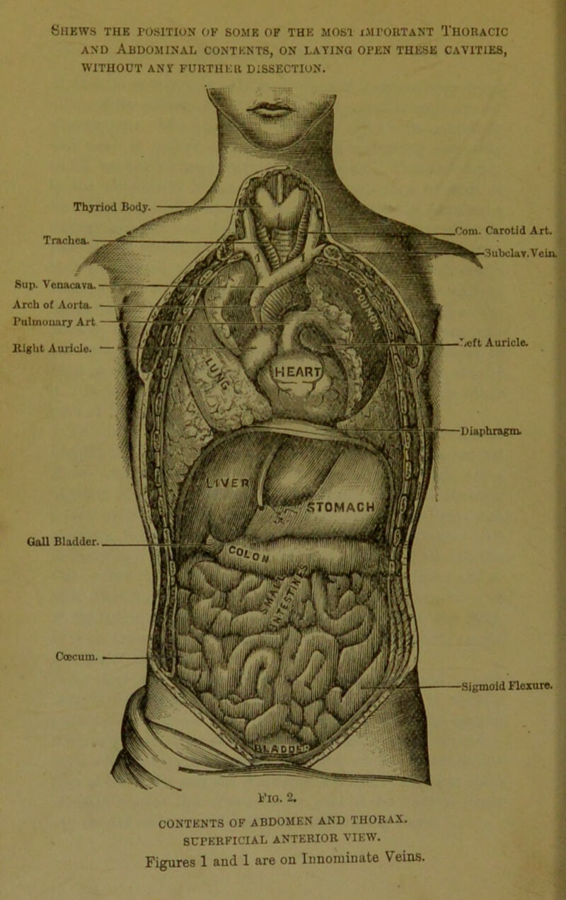 Shews the position op some of the most important Thoracic and Abdominal contents, on lating open these cavities, WITHOUT ANY FURTHER DISSECTION. Gall Bladder. Flo. 2. Flexure. Thyriod Body. Trachea. I Sup. Venacava.—^ Arch of Aorto- Pulmonary Art Right Auricle. Com. Carotid Art. 3ubelav.Vein. Auricle. CONTENTS OF ABDOMEN AND THORAX. SUPERFICIAL ANTERIOR VIEW. Figures 1 and 1 are on Innominate Veins.