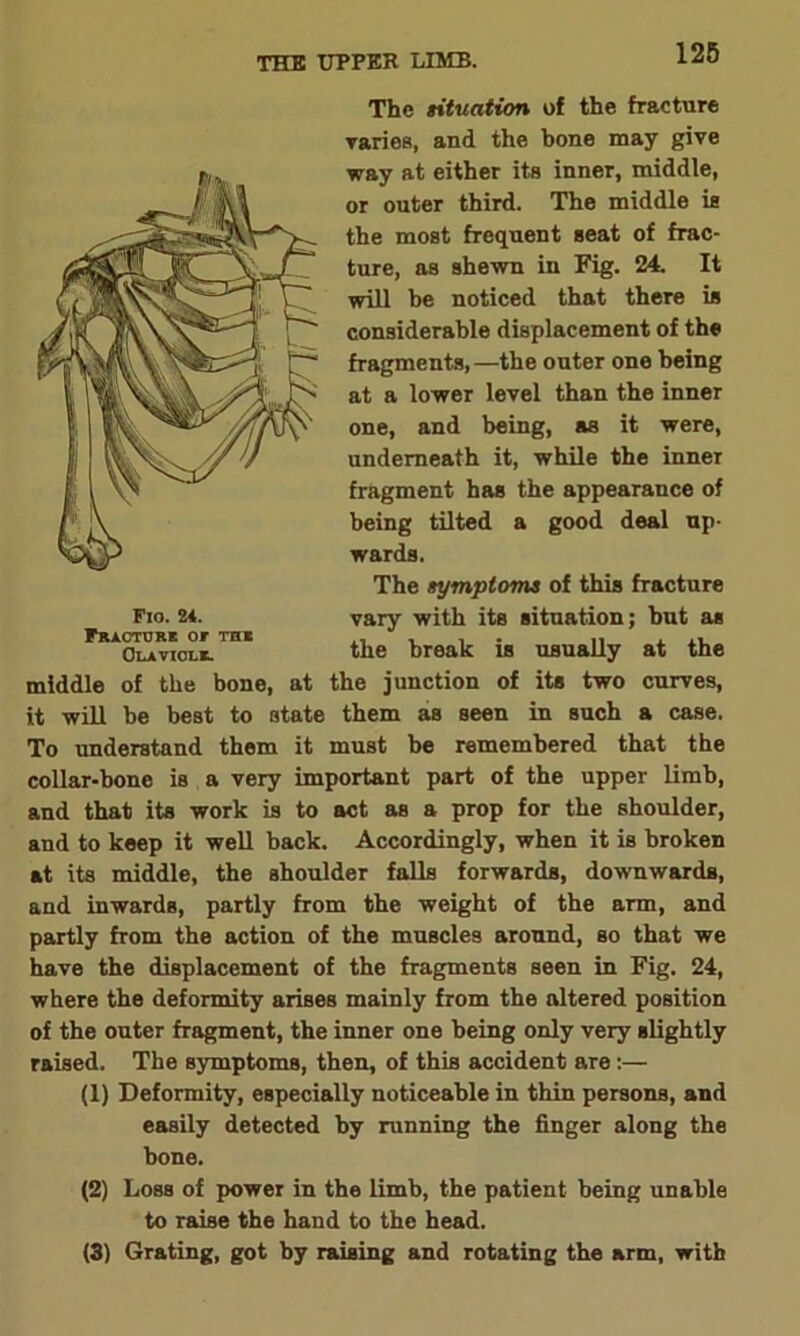 The situation of the fracture varies, and the bone may give way at either its inner, middle, or outer third. The middle is the most frequent seat of frac- ture, as shewn in Fig. 24. It will he noticed that there is considerable displacement of the fragments, —the outer one being at a lower level than the inner one, and being, as it were, underneath it, while the inner fragment has the appearance of being tilted a good deal up- wards. The symptoms of this fracture vary with its situation; but as the break is usually at the middle of the bone, at the junction of its two curves, it will be best to state them as seen in such a case. To understand them it must be remembered that the collar-bone is a very important part of the upper limb, and that its work is to act as a prop for the shoulder, and to keep it well back. Accordingly, when it is broken at its middle, the shoulder falls forwards, downwards, and inwards, partly from the weight of the arm, and partly from the action of the muscles around, so that we have the displacement of the fragments seen in Fig. 24, where the deformity arises mainly from the altered position of the outer fragment, the inner one being only very slightly raised. The symptoms, then, of this accident are:— (1) Deformity, especially noticeable in thin persons, and easily detected by running the finger along the bone. (2) Loss of power in the limb, the patient being unable to raise the hand to the head. (3) Grating, got by raising and rotating the arm, with Flo. 24. Fracture or the Clavicle.