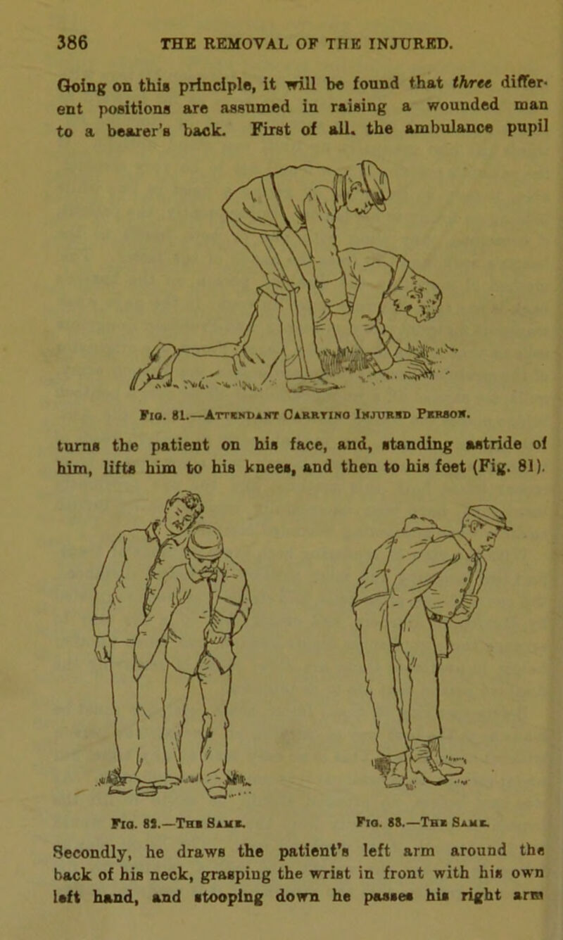 Going on this principle, it will be found that three differ- ent positions are assumed in raising a wounded man to a bearer’s back. First of all. the ambulance pupil Fio. 81.—ATTENDANT CaRRYINO IXJURRD PKRSOR. turns the patient on his face, and, standing astride of him, lifts him to his knees, and then to his feet (Fig. 81). Flo. 81.—Thb Hiuc. Fio. 88.—The Same. Secondly, he draws the patient’s left arm around the back of his neck, grasping the wrist in front with his own left hand, and stooping down he passes his right arm