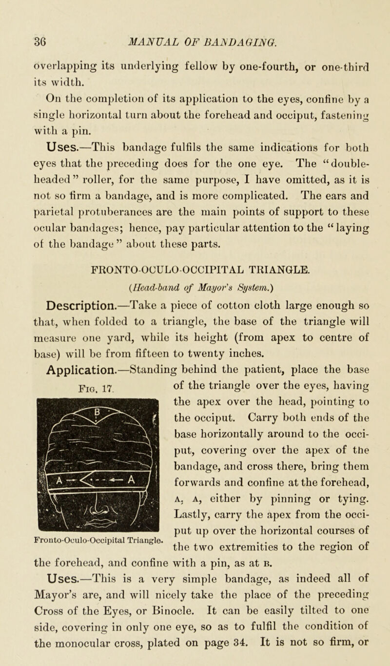 overlapping its underlying fellow by one-fourth, or one-third its width. On the completion of its application to the eyes, confine by a single horizontal turn about the forehead and occiput, fastening with a pin. Uses.—This bandage fulfils the same indications for both eyes that the preceding does for the one eye. The “double- headed ” roller, for the same purpose, I have omitted, as it is not so firm a bandage, and is more complicated. The ears and parietal protuberances are the main points of support to these ocular bandages; hence, pay particular attention to the “ laying of the bandage ” about these parts. FRONTO-OCULO OCCIPITAL TRIANGLE. (Head-band of Mayor's System.) Description.—Take a piece of cotton cloth large enough so that, when folded to a triangle, the base of the triangle will measure one yard, while its height (from apex to centre of base) will be from fifteen to twenty inches. Application.—Standing behind the patient, place the base of the triangle over the eyes, having the apex over the head, pointing to the occiput. Carry both ends of the base horizontally around to the occi- put, covering over the apex of the bandage, and cross there, bring them forwards and confine at the forehead, a. a, either by pinning or tying. Lastly, carry the apex from the occi- put up over the horizontal courses of Fronto-Oculo-Occipital Triangle. . . . . . c the two extremities to the region ot the forehead, and confine with a pin, as at b. Uses.—This is a very simple bandage, as indeed all of Mayor’s are, and will nicely take the place of the preceding Cross of the Eyes, or Binocle. It can be easily tilted to one side, covering in only one eye, so as to fulfil the condition of the monocular cross, plated on page 34, It is not so firm, or Fig. 17.