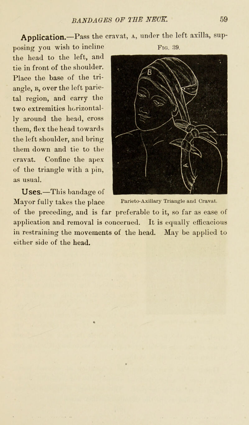 Application.—Pass the cravat, a, under the left axilla, sup- posing you wish to incline Fto. 89. the head to the left, and tie in front of the shoulder. Place the base of the tri- angle, b, over the left parie- tal region, and carry the two extremities horizontal- ly around the head, cross them, flex the head towards the left shoulder, and bring them down and tie to the cravat. Confine the apex of the triangle with a pin, as usual. Uses.—This bandage of Mayor fully takes the place Parieto-Axillary Triangle and Cravat, of the preceding, and is far preferable to it, so far as ease of application and removal is concerned. It is equally efficacious in restraining the movements of the head. May be applied to either side of the head.