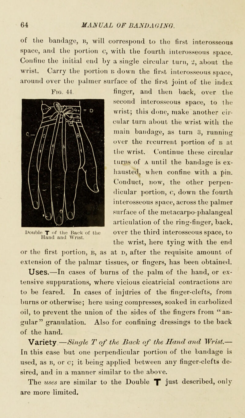 of the bandage, b, will correspond to the first interosseous space, and the portion c, with the fourth interosseous space. Confine the initial end by a single circular turn, 2, about the wrist. Carry the portion b down the first interosseous space, around over the palmer surface of the first joint of the index Fra. 44. finger, and then back, over the second interosseous space, to the wrist; this done, make another cir- cular turn about the wrist with the main bandage, as turn 3, running over the recurrent portion of b at the wrist. Continue these circular turns of a until the bandage is ex- hausted, when confine with a pin. Conduct, now, the other perpen- dicular portion, c, down the fourth interosseous space, across the palmer surface of the metacarpo phalangeal articulation of the ring-finger, back, over the third interosseous space, to the wrist, here tying with the end or the first portion, b, as at i>, after the requisite amount of extension of the palmar tissues, or fingers, has been obtained. Uses.—In cases of burns of the palm of the hand, or ex- tensive suppurations, where vicious cicatricial contractions are to be feared. In cases of injuries of the finger-clefts, from burns or otherwise; here using compresses, soaked in carbolized oil, to prevent the union of the sides of the fingers from “ an- gular ” granulation. Also for confining dressings to the back of the hand. Variety.—Single T of the Back of the Hand and Wrist.— In this case but one perpendicular portion of the bandage is used, as b, or c; it being applied between any finger-clefts de- sired, and in a manner similar to the above. The uses are similar to the Double T just described, only are more limited. Double T of the Back of the Hand and Wrist.