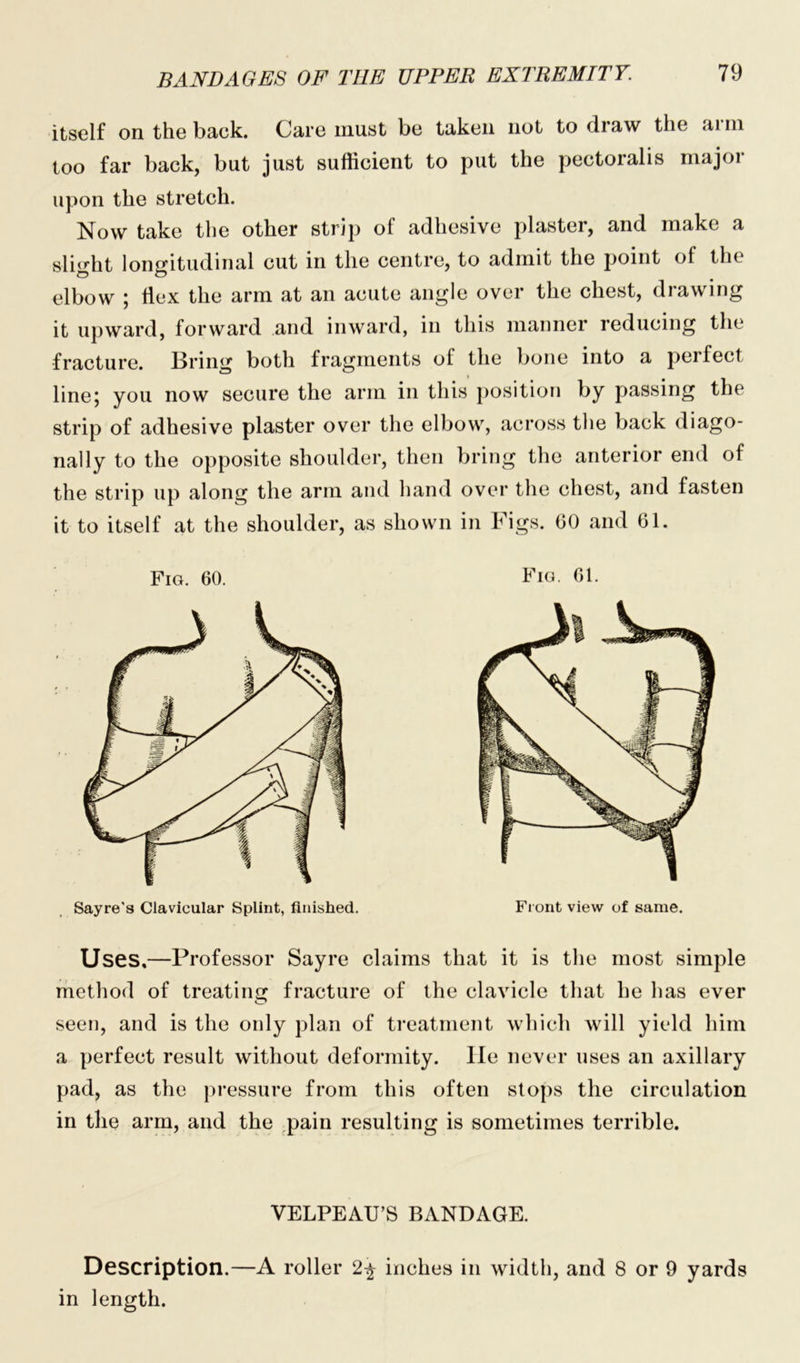 itself on the back. Care must be taken not to draw the <11 in too far back, but just sufficient to put the pectoralis major upon the stretch. Now take the other strip of adhesive plaster, and make a slight longitudinal cut in the centre, to admit the point of the elbow ; Ilex the arm at an acute angle over the chest, drawing it upward, forward and inward, in this manner reducing the fracture. Bring both fragments of the bone into a perfect line; you now secure the arm in this position by passing the strip of adhesive plaster over the elbow, across the back diago- nally to the opposite shoulder, then bring the anterior end of the strip up along the arm and hand over the chest, and fasten it to itself at the shoulder, as shown in Figs. 60 and 61. Fig. 61. Front view of same. Fig. 60. Sayre's Clavicular Splint, finished. Uses,—Professor Sayre claims that it is the most simple method of treating fracture of the clavicle that he has ever seen, and is the only plan of treatment which will yield him a perfect result without deformity, lie never uses an axillary pad, as the pressure from this often stops the circulation in the arm, and the pain resulting is sometimes terrible. VELPEAU’S BANDAGE. Description.—A roller 2^ inches in width, and 8 or 9 yards in length.