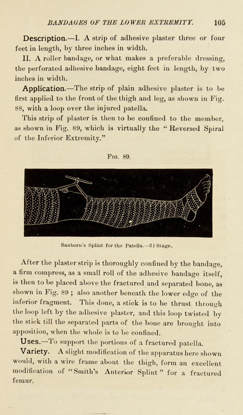 Description.—I. A strip of adhesive plaster three or four feet in length, by three inches in width. II. A roller bandage, or what makes a preferable dressing, the perforated adhesive bandage, eight feet in length, by two inches in width. Application.—The strip of plain adhesive plaster is to be first applied to the front of the thigh and leg, as shown in Fig. 88, with a loop over the injured patella. This strip of plaster is then to be confined to the member, as shown in Fig. 89, which is virtually the “ Reversed Spiral of the Inferior Extremity.” Fro. 89. Sanborn's Splint for the Patella.—2 1 Stage. After the plaster strip is thoroughly confined by the bandage, a firm compress, as a small roll of the adhesive bandage itself, is then to be placed above the fractured and separated bone, as shown in Fig. 89 ; also another beneath the lower edge of the a0 ^ e n t. This done, a stick is to be thrust through the loop left by the adhesive plaster, and this loop twisted by the stick till the separated parts of tire bone are brought into apposition, when the whole is to be confined. Uses.—To support the portions of a fractured patella. Variety. A slight modification of the apparatus here shown would, with a wire frame about the thigh, form an excellent modification of “Smith’s Anterior Splint” for a fractured femur.