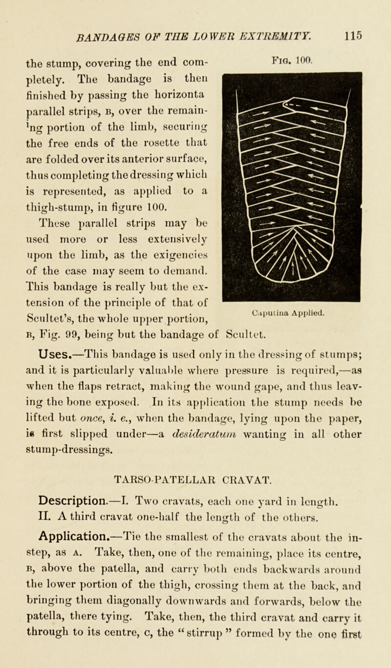 the stump, covering the end com- pletely. The bandage is then finished by passing the horizonta parallel strips, b, over the remain- ing portion of the limb, securing the free ends of the rosette that are folded over its anterior surface, thus completing the dressing which is represented, as applied to a thigh-stump, in figure 100. These parallel strips may be used more or less extensively upon the limb, as the exigencies of the case may seem to demand. This bandage is really but the ex- tension of the principle of that of Scultet’s, the whole upper portion, b, Fig. 99, being but the bandage of Scultet. Uses.—This bandage is used only in the dressing of stumps; and it is particularly valuable where pressure is required,—as when the flaps retract, making the wound gape, and thus leav- ing the bone exposed. In its application the stump needs be lifted but once, i. e., when the bandage, lying upon the paper, i« fi rst slipped under—a desideratum wanting in all other stump-dressings. Fig. 100. Capulina Applied. TARSO PATELLAR CRAVAT. Description.—I. Two cravats, each one yard in length. II. A third cravat one-half the length of the others. Application.—Tie the smallest of the cravats about the in- step, as a. Take, then, one of the remaining, place its centre, b, above the patella, and carry both ends backwards around the lower portion of the thigh, crossing them at the back, and bringing them diagonally downwards and forwards, below the patella, there tying. Take, then, the third cravat and carry it through to its centre, c, the “ stirrup ” formed by the one first