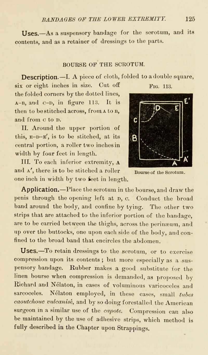 Uses.—As a suspensory bandage for the scrotum, and its contents, and as a retainer of dressings to the parts. BOURSE OF THE SCROTUM. Description.—I. A piece of cloth, folded to a double square, six or eight inches in size. Cut off Fig. 113. the folded corners by the dotted lines, a-b, and c-d, in figure 113. It is then to be stitched across, from A to b, and from c to d. II. Around the upper portion of this, e-d-e', is to be stitched, at its central portion, a roller two inches in width by four feet in length. III. To each inferior extremity, A and a', there is to be stitched a roller Bourse of the Scrotum, one inch in width by two Seet in length. Application.—Place the scrotum in the bourse, and draw the penis through the opening left at d, c. Conduct the broad band around the body, and confine by tying. The other two strips that are attached to the inferior portion of the bandage, are to be carried between the thighs, across the perinaeum, and up over the buttocks, one upon each side of the body, and con- fined to the broad band that encircles the abdomen. Uses.—To retain dressings to the scrotum, or to exercise compression upon its contents ; but more especially as a sus- pensory bandage. Rubber makes a good substitute for the linen bourse when compression is demanded, as proposed by Richard and Nelaton, in cases of voluminous varicoceles and sarcoceles. Nelaton employed, in these cases, small tubes caoutchouc vulcanise, and by so doing forestalled the American surgeon in a similar use of the capote. Compression can also be maintained by the use of adhesive strips, which method is fully described in the Chapter upon Strappings.