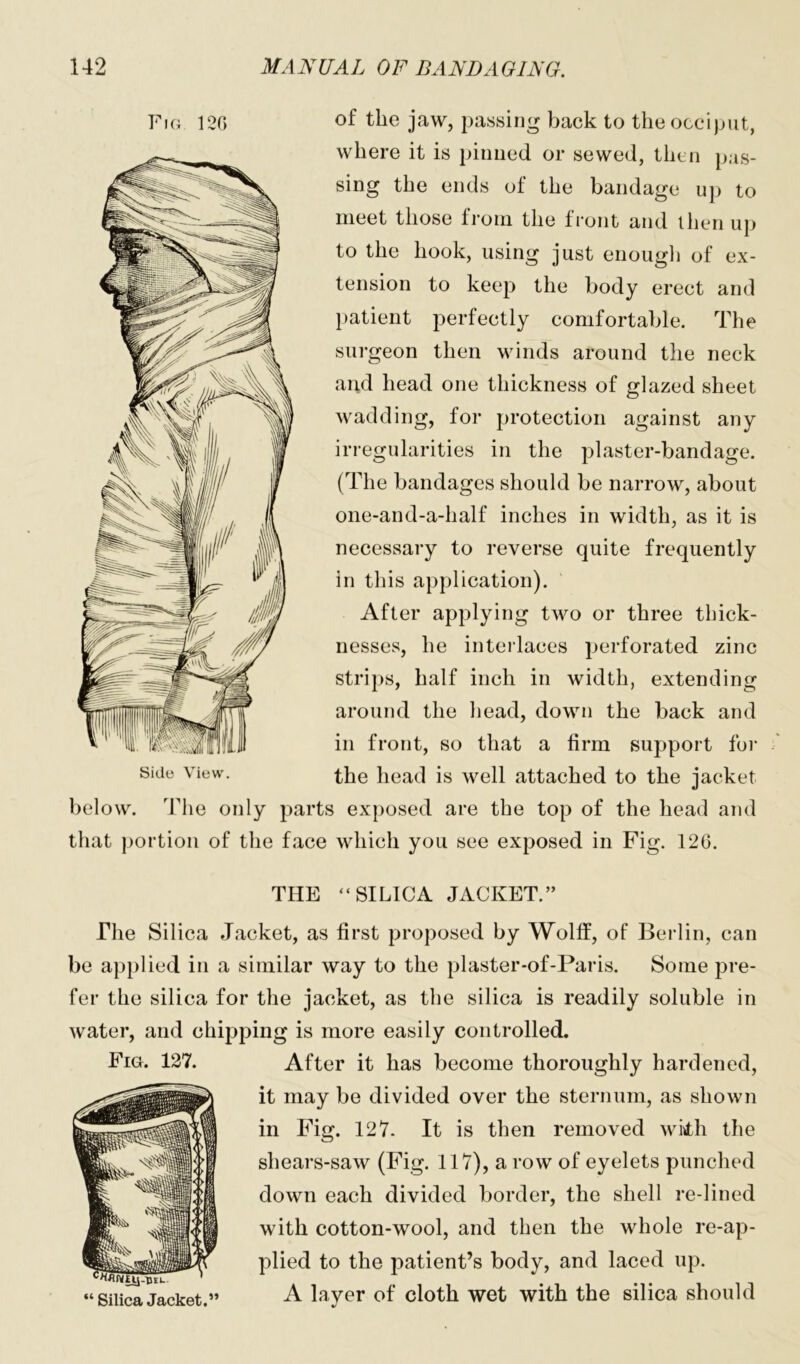 Fig 126 °f the jaw, passing back to the occiput, where it is pinned or sewed, then pas- sing the ends of the bandage up to meet those from the front and then up to the hook, using just enough of ex- tension to keep the body erect and patient perfectly comfortable. The surgeon then winds around the neck and head one thickness of glazed sheet wadding, for protection against any irregularities in the plaster-bandage. (The bandages should be narrow, about one-and-a-half inches in width, as it is necessary to reverse quite frequently in this application). After applying two or three thick- nesses, he interlaces perforated zinc strips, half inch in width, extending around the head, down the back and in front, so that a firm support for the head is well attached to the jacket below. The only parts exposed are the top of the head and that portion of the face which you see exposed in Fig. 126. THE “SILICA JACKET.” The Silica Jacket, as first proposed by Wolff, of Berlin, can be applied in a similar way to the plaster-of-Paris. Some pre- fer the silica for the jacket, as the silica is readily soluble in water, and chipping is more easily controlled. After it has become thoroughly hardened, it may be divided over the sternum, as shown in Fig. 127. It is then removed with the shears-saw (Fig. 117), a row of eyelets punched down each divided border, the shell re-lined with cotton-wool, and then the whole re-ap- plied to the patient’s body, and laced up. A layer of cloth wet with the silica should Fig. 127. “ Silica Jacket.”