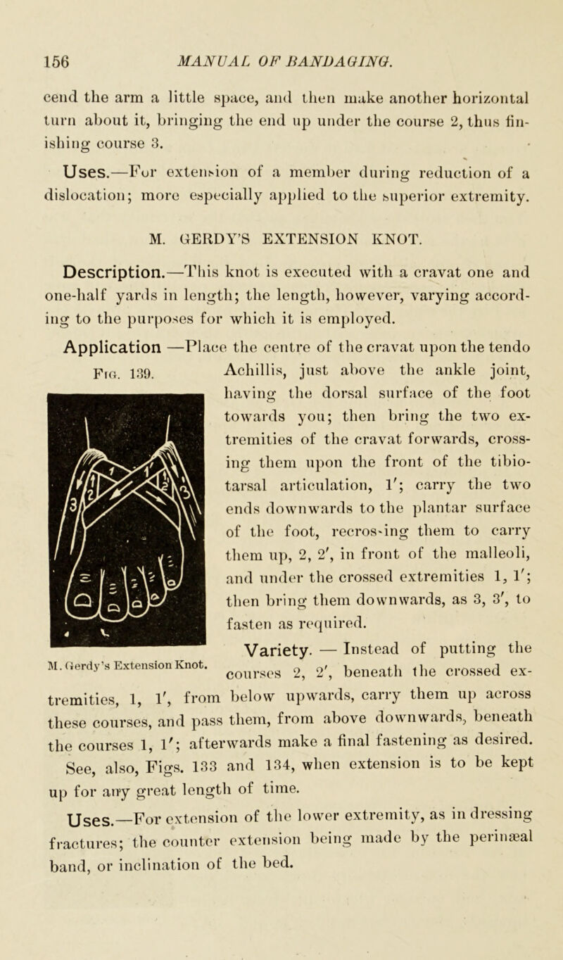 cenci the arm a little space, and then make another horizontal turn about it, bringing the end up under the course 2, thus fin- ishing course 3. Uses.—Fur extension of a member during reduction of a dislocation; more especially applied to the superior extremity. M. GERDY’S EXTENSION KNOT. Description.—This knot is executed with a cravat one and one-half yards in length; the length, however, varying accord- ing to the purposes for which it is employed. Application —Place the centre of the cravat upon the tendo prG p39 Achillis, just above the ankle joint, having1 the dorsal surface of the foot towards you; then bring the two ex- tremities of the cravat forwards, cross- ing them upon the front of the tibio- tarsal articulation, 1'; carry the two ends downwards to the plantar surface of the foot, recros'ing them to carry them up, 2, 2', in front of the malleoli, and under the crossed extremities 1, 1'; then bring them downwards, as 3, 3', to fasten as required. Variety. — Instead of putting the courses 2, 2', beneath the crossed ex- tremities, 1, T, from below upwards, carry them up across these courses, and pass them, from above downwaids, beneath the courses 1, 1'; afterwards make a final fastening as desired. See, also, Figs. 133 and 134, when extension is to be kept up for any great length of time. Uses.—For extension of the lower extremity, as in dressing fractures; the counter extension being made by the perinaeal band, or inclination of the bed. M. Cierdy’s Extension Knot.