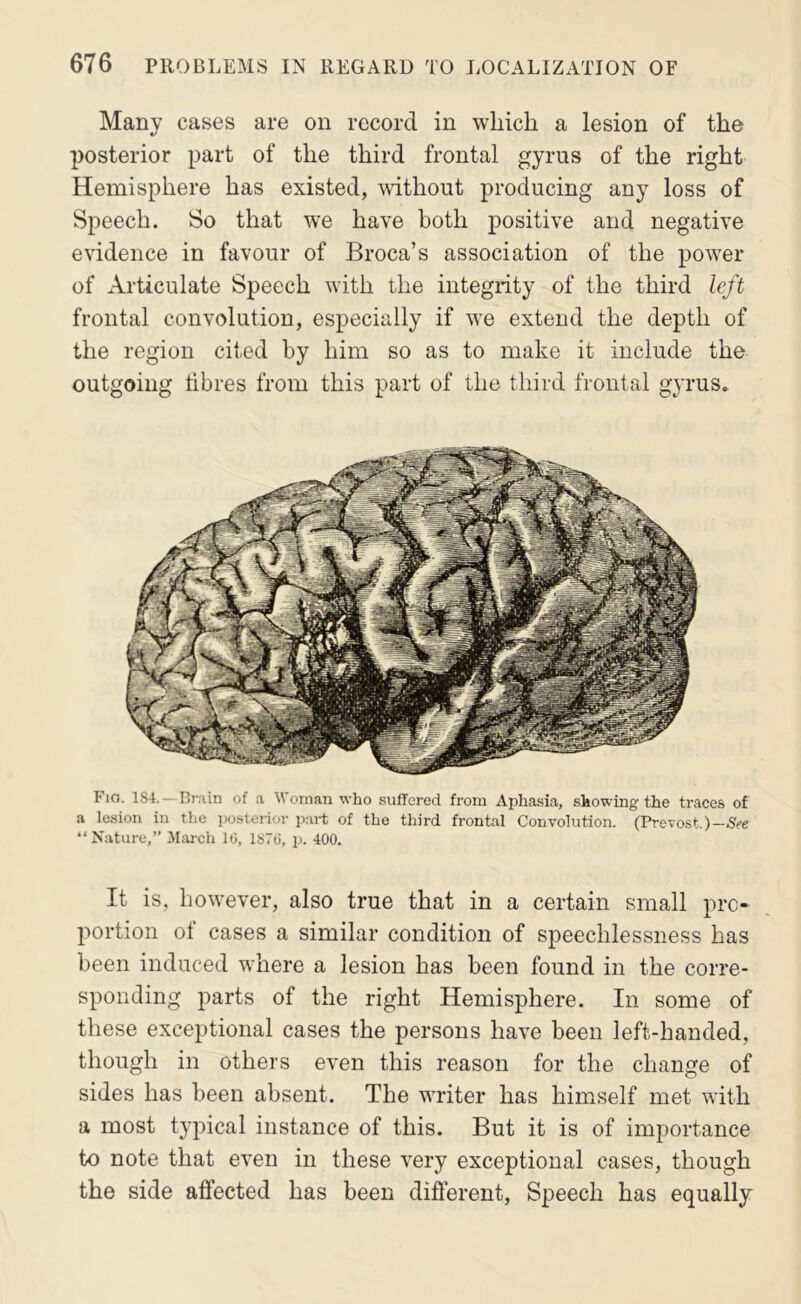 Many cases are on record in which a lesion of the posterior part of the third frontal gyrus of the right Hemisphere has existed, without producing any loss of Speech. So that we have both positive and negative evidence in favour of Broca’s association of the power of Articulate Speech with the integrity of the third left frontal convolution, especially if we extend the depth of the region cited by him so as to make it include the outgoing fibres from this part of the third frontal gyrus. Fio. 1S4. — Brain of a Woman who suffered from Aphasia, showing the traces of a lesion in the posterior part of the third frontal Convolution. (Prevost.)-Sf>e “Nature,” March l(i, ISTiJ, 2x 400. It is, however, also true that in a certain small pre- portion of cases a similar condition of speechlessness has been induced where a lesion has been found in the corre- sponding parts of the right Hemisphere. In some of these exceptional cases the persons have been left-handed, though in others even this reason for the change of sides has been absent. The writer has himself met with a most typical instance of this. But it is of importance to note that even in these very exceptional cases, though the side affected has been different. Speech has equally