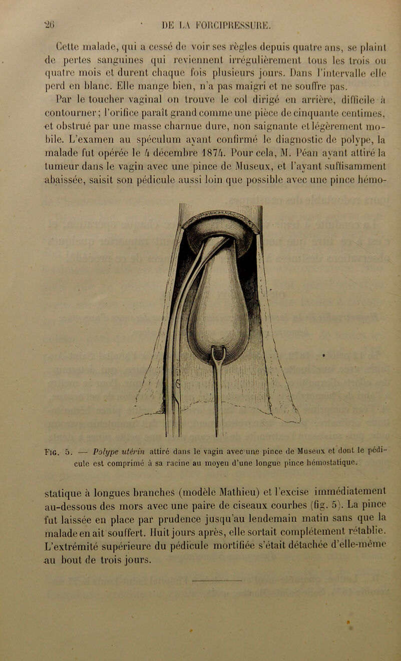 Cette malade, qui a cessé de voir ses règles depuis quatre ans, se plaint de pertes sanguines qui reviennent irrégulièrement tous les trois ou quatre mois et durent chaque fois plusieurs jours. Dans l’intervalle elle perd en blanc. Elle mange bien, n’a pas maigri et ne souffre pas. Par le toucher vaginal on trouve le col dirigé en arrière, difficile à contourner; l’orifice paraît grand comme une pièce de cinquante centimes, et obstrué par une masse charnue dure, non saignante et légèrement mo- bile. L’examen au spéculum ayant confirmé le diagnostic de polype, la malade fut opérée le 4 décembre 1874. Pour cela, M. Péan ayant attiré la tumeur dans le vagin avec une pince de Museux, et l’ayant suffisamment abaissée, saisit son pédicule aussi loin que possible avec une pince hémo- Fig. 5. — Polype utérin attiré dans le vagin avec'une pince de Museux et dont le pédi- cule est comprimé à sa racine au moyen d’une longue pince hémostatique. statique à longues branches (modèle Mathieu) et l’excise immédiatement au-dessous des mors avec une paire de ciseaux courbes (fig. 5). La pince fut laissée en place par prudence jusqu’au lendemain matin sans que la malade en ait souffert. Huit jours après, elle sortait complètement rétablie. L’extrémité supérieure du pédicule mortifiée s’était détachée d’elle-même au bout de trois jours.