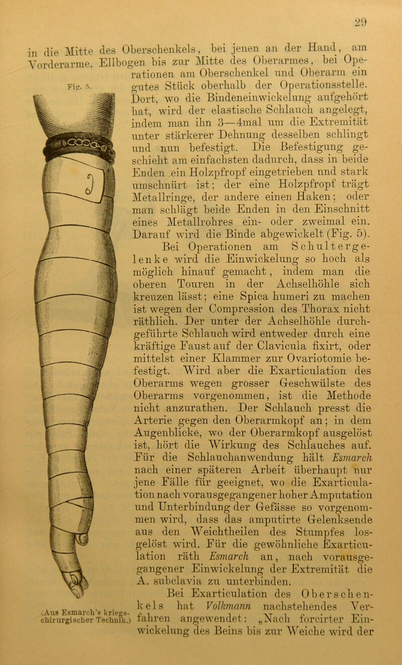 m Fi«:. 5. die Mitte des Oberschenkels, bei jenen an der Hand, am Vorderarme, Ellbogen bis zur Mitte des Oberarmes, bei Ope- rationen am Oberschenkel und Oberarm ein gutes Stück oberhalb der Operationsstelle. Dort, wo die Bindeneinwickelung aufgehört hat, wird der elastische Schlauch angelegt, indem man ihn 3—4mal um die Extremität unter stärkerer Dehnung desselben schlingt und nun befestigt. Die Befestigung ge- schieht am einfachsten dadurch, dass in beide Enden ein Holzpfropf eingetrieben und stark umschnürt ist; der eine Holzpfropf trägt Metallringe, der andere einen Haken; oder man schlägt beide Enden in den Einschnitt eines Metallrohres ein- oder zweimal ein. Darauf wird die Binde abgewickelt (Fig. 5). Bei Operationen am S c h u 11 e r g e- lenke wird die Einwickelung so hoch als möglich hinauf gemacht, indem man die oberen Touren in der Achselhöhle sich kreuzen lässt; eine Spica hmneri zu machen ist wegen der Compression des Thorax nicht räthlich. Der unter der Achselhöhle durch- geführte Schlauch wird entweder durch eine kräftige Faust auf der Clavicula fixirt, oder mittelst einer Klammer zur Ovariotomie be- festigt. Wird aber die Exarticulation des Oberarms wegen grosser Geschwülste des Oberarms vorgenommen, ist die Methode nicht anzurathen. Der Schlauch presst die Arterie gegen den Oberarmkopf an; in dem Augenblicke, wo der Oberarmkopf ausgelöst ist, hört die Wirkung des Schlauches auf. Für die Schlauchanwendung hält Esmarch nach einer späteren Arbeit überhaupt nur jene Fälle für geeignet, wo die Exarticula- tion nach vorausgegangener hoher Amputation und Unterbindung der Gefässe so vorgenom- men wird, dass das amputirte Gelenksende aus den Weichtheilen des Stumpfes los- gelöst wird. Für die gewöhnliche Exarticu- lation räth Esmarch an, nach vorausge- gangener Einwickelung der Extremität die A. subclavia zu unterbinden. Bei Exarticulation des 0berschen- „ , kels hat Volkmann nachstehendes Ver- ;Aus Esmarch s kriegB- n ^ i i i n • . chirurgischer Technik.) tahren angewendet: „Nach lorcirter Ein- wickelung des Beins bis zur Weiche wird der