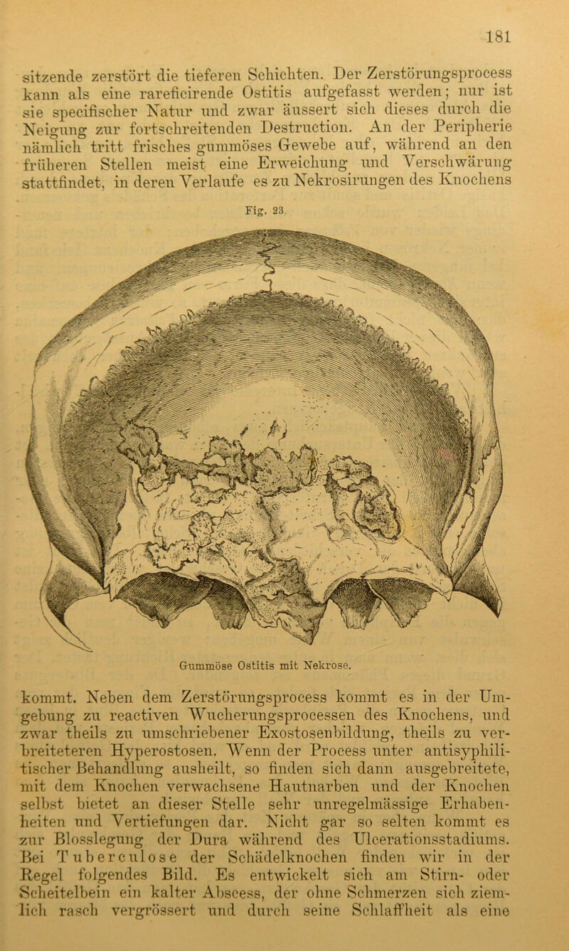 sitzende zerstört die tieferen Schichten. Der Zerstörungsprocess kann als eine rareficirende Ostitis aufgefasst werden; nur ist sie specifischer Natur und zwar äussert sich dieses durch die Neigung zur fortschreitenden Destruction. An der Peripherie nämlich tritt frisches gummöses Gewebe auf, während an den früheren Stellen meist eine Erweichung und Verschwärung stattfindet, in deren Verlaufe es zu Nekrosirungen des Knochens Fig. 23. Gummöse Ostitis mit Nekrose. kommt. Neben dem Zerstörungsprocess kommt es in der Um- gebung zu reactiven Wucherungsprocessen des Knochens, und zwar theils zu umschriebener Exostosenbildung, theils zu ver- breiteteren Hyperostosen. Wenn der Process unter antisyphili- tischer Behandlung ausheilt, so finden sich dann ausgebreitete, mit dem Knochen verwachsene Hautnarben und der Knochen selbst bietet an dieser Stelle sehr unregelmässige Erhaben- heiten und Vertiefungen dar. Nicht gar so selten kommt es zur Blosslegung der Dura während des Ulcerationsstadiums. Bei Tuberculose der Schädelknochen finden wir in der Kegel folgendes Bild. Es entwickelt sich am Stirn- oder Scheitelbein ein kalter Abscess, der ohne Schmerzen sich ziem- lich rasch vergrÖ3sert und durch seine Schlaffheit als eine