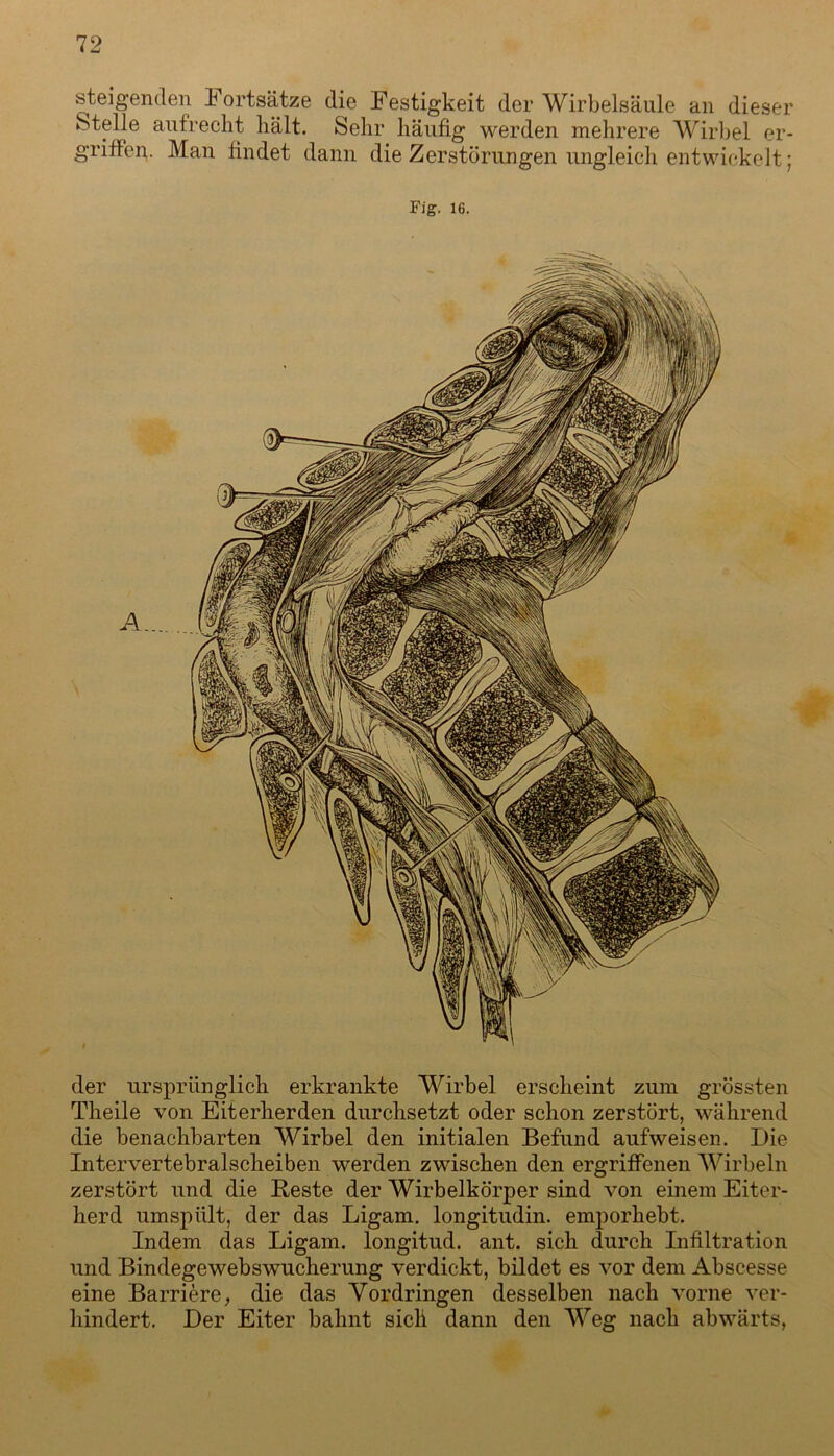 steigenden Fortsätze die Festigkeit der Wirbelsäule an dieser Stelle aufrecht hält. Sehr häufig werden mehrere Wirbel er- griffen. Man findet dann die Zerstörungen ungleich entwickelt; Fig. 16. der ursprünglich erkrankte Wirbel erscheint zum grössten Theile von Eiterherden durchsetzt oder schon zerstört, während die benachbarten Wirbel den initialen Befund aufweisen. Die Intervertebralscheiben werden zwischen den ergriffenen Wirbeln zerstört und die Reste der Wirbelkörper sind von einem Eiter- herd umspiilt, der das Ligam. longitudin. emporhebt. Indem das Ligam. longitud. ant. sich durch Infiltration und Bindegewebswucherung verdickt, bildet es vor dem Abscesse eine Barriere, die das Vordringen desselben nach vorne ver- hindert. Der Eiter bahnt sich dann den Weg nach abwärts,