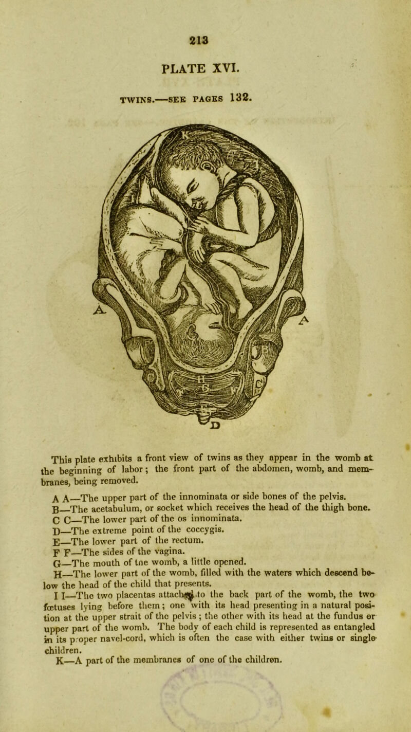 213 PLATE XVI. This plate exhibits a front view of twins as they appear in the womb at the beginning of labor; the front part of the abdomen, womb, and mem- branes, being removed. A a The upper part of the innominata or side bones of the pelvis. The acetabulum, or socket which receives the head of the thigh bone. C C—The lower part of the os innominata. D—The extreme point of the coccygis. E The lower part of the rectum. F F—The sides of the vagina. G The mouth of tne womb, a little opened. jj The lower part of the womb, fdled with the waters which descend be- low the head of the child that presents. I I The two placentas attach^ to the back part of the womb, the two foetuses lying before them; one with its head presenting in a natural posi- tion at the upper strait of the pelvis; the other with its head at the fundus or upper part of the womb. The body of each child is represented as entangled in its p oper navel-cord, which is often the case with either twins or single- children. K A part of the membranes of one of the children.