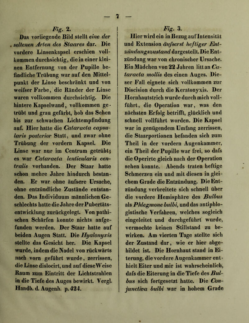 Fig. 2. Das vorliegende Bild stellt eine der . seltenen Arten des Staares dar. Die vordere Linsenkapsel erschien voll- kommen durchsichtig, die in einer klei- nen Entfernung von der Pupille be- findliche Trübung war auf den Mittel- punkt der Linse beschränkt und von weifser Farbe, die Ränder der Linse waren vollkommen durchsichtig. Die hintere Kapselwand, vollkommen ge- trübt und grau gefärbt, hob das Sehen bis zur schwachen Lichtempfindung auf. Hier hatte die Cataracta capsu- laris posterior Statt, und zwar ohne Trübung der vordem Kapsel. Die Linse war nur im Centrum getrübt; es war Cataracta lenticularis cen- tralis vorhanden. Der Staar hatte schon mehre Jahre hindurch bestan- den. Er war ohne äufsere Ursache, ohne entzündliche Zustände entstan- den. Das Individuum männlichen Ge- schlechts hatte die Jahre der Pubertäts- entwicklung zurückgelegt. Yonpathi- schen Schärfen konnte nichts anfge- funden werden. Der Staar hatte auf beiden Augen Statt. Die Hyalonyxis stellte das Gesicht her. Die Kapsel wurde, indem die Nadel von rückwärts nach vorn geführt wurde, zerrissen, die Linse dislocirt, und auf dieseWeise Raum zum Eintritt der Lichtstrahlen in die Tiefe des Auges bewirkt. Vergl. Handb. d. Augenh. p. 424. Fig. 3. Hier wird ein in Bezug auf Intensität und Extension äufserst heftiger Ent- zündungszustand dargestellt. Die Ent- zündung war von chronischer Ursache. Ein Mädchen von 22 Jahren litt an Ca- taracta mollis des einen Auges. Die- ser Fall eignete sich vollkommen zur Discision durch die Keratonyxis. Der Hornhautstrich wurde durch mich voll- führt, die Operation war, was den nächsten Erfolg betrifft, glücklich und schnell vollführt worden. Die Kapsel war in genügendem Umfang zerrissen, die Staarportionen befanden sich zum Theil in der vordem Augenkammer, ein Theil der Pupille war frei, so dafs die Operirte gleich nach der Operation sehen konnte. Abends traten heftige Schmerzen ein und mit diesen in glei- chem Grade die Entzündung. Die Ent- zündung verbreitete sich schnell über die vordere Hemisphäre des Bulbus als Phlegmone bulbi, und das antiphlo- gistische Verfahren, welches sogleich eingeleitet und durchgeführt wurde, vermochte keinen Stillstand zu be- wirken. Am vierten Tage stellte sich der Zustand dar, wie er hier abge- bildet ist. Die Hornhaut stand in Ei- terung, die vordere Augenkammer ent- hielt Eiter und mir ist wahrscheinlich, dafs die Eiterung in die Tiefe des Bul- bus sich fortgesetzt hatte. Die Con- junctiva bulbi war in hohem Grade