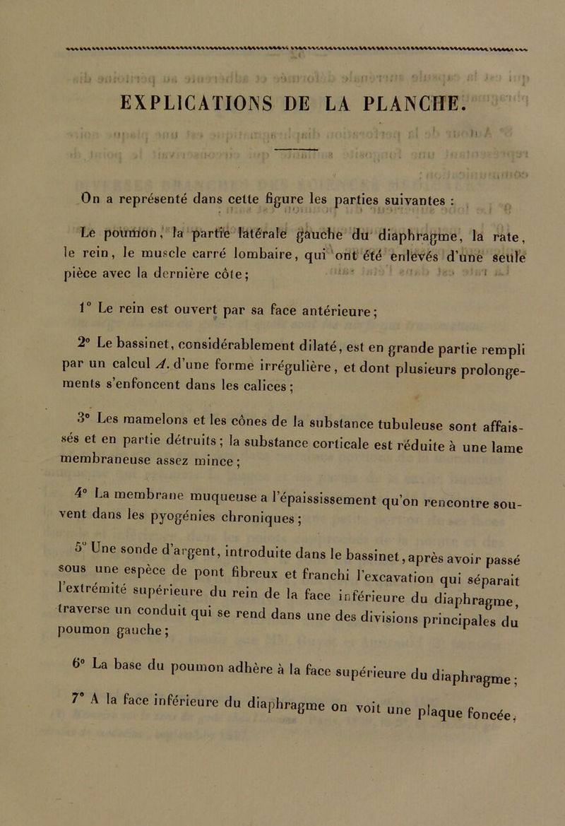 «U\WVlit«UU«U\U%1 V\1MUMVitMVUM«U\ VUMA EXPLICATIONS DE LA PLANCHE. r < : ■ i .' (■ ;m • . : . < :' • ’ i 0 On a représenté dans celte figure les parties suivantes : Le poumon, la partie latérale gauche du diaphragme, la rate, le rein, le muscle carré lombaire, qui ont été enlevés d’une seule pièce avec la dernière côte; 1° Le rein est ouvert par sa face antérieure; 2° Le bassinet, considérablement dilaté, est en grande partie rempli par un calcul A. d’une forme irrégulière, et dont plusieurs prolonge- ments s’enfoncent dans les calices; 3° Les mamelons et les cônes de la substance tubuleuse sont affais- sés et en partie détruits ; la substance corticale est réduite à une lame membraneuse assez mince; 4 La membrane muqueuse a 1 épaississement qu’on rencontre sou vent dans les pyogénies chroniques; Une SOncle d’arGent' introduite dans le bassinet .après avoir passé sous une espece de pont fibreux et franchi l’excavation qui séparait extrémité supérieure du rein de la face inférieure du diaphragme traverse un conduit qui se rend dans une des divisions principales dj poumon gauche; 1 6” La base du poumon adhère à la face supérieure du diaphragme; T A la faCC intér',eare du diapl»’aB»e on voit une plaque foncée.