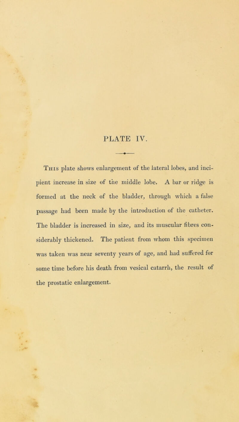 This plate shows enlargement of the lateral lobes, and inci- pient increase in size of the middle lobe. A bar or ridge is formed at the neck of the bladder, through which a false passage had been made by the introduction of the catheter. The bladder is increased in size, and its muscular fibres con- siderably thickened. The patient from whom this specimen was taken was near seventy years of age, and had suffered for some time before his death from vesical catarrh, the result of the prostatic enlargement.