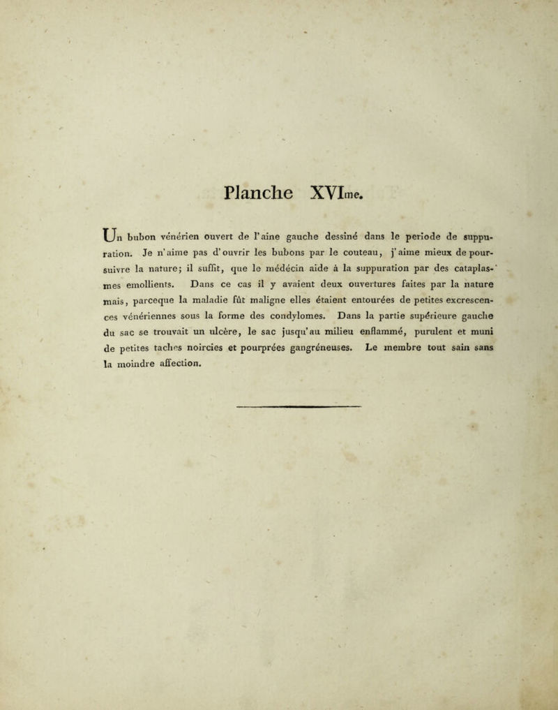Un bubon venerien ouvert de l’aine gauche dessind dans le perlode de suppu- ration. Je n’aime pas d’ouvrir les bubons par le couteau, j’aime mieux de pour- suivre la nature; il suffit, que le medecin aide a la suppuration par des cataplas- mes emollients. Dans ce cas il y avaient deux ouvertures faites par la nature mais, parceque la maladie fut maligne elles ^taient entour^es de petites excrescen- ces veneriennes sous la forme des condylomes. Dans la partie sup^tieure gauche du sac se trouvait un ulcere, le sac jusqu’au milieu enflamme, purulent et muni de petites taches noircies et pourpr^es gangreneuses. Le znembre tout sain sans la moindre affection.