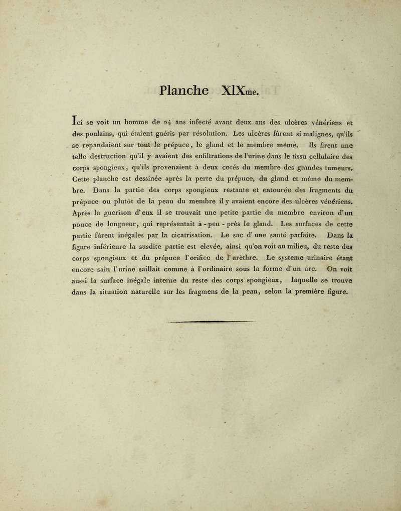 Ici se voit un homme de 24 ens infecte avant deux ans des ulceres v^neriens et des poulains, qui etaient gueris par resolution. Les ulceres furent si malignes, qu’ils se repandaient sur tout Ie prepuce, le gland et le membre m6me. Ils firent une telle destruction qu’il y avaient des enfiltrations de l’urine dans le tissu cellulaire des corps spongieux, qu’ils provenaient a deux cotes du membre des grandes tumeurs, Cette planche est dessinee apr6s la perte du prepuce, du gland et meme du mem- bre. Dans la partie des corps spongieux restante et entouree des fragments du prepuce ou plutot de la peau du membre il y avaient encore des ulceres vendriens. Aprtis la guerison d’eux il se trouvait une petite partie du membre environ d’un pouce de longueur, qui representait a-peu-pres le gland. Les surfaces de cette partie fiirent inegales par la cicatrisation. Le sac d’ une sante parfaite. Dans la figure inferieure la susdite partie est elevee, ainsi qu’on voit au milieu, du reste des corps spongieux et du prepuce 1’orifice de 1’ urethre. Le systeme urinaire etant encore sain V urine saillait comme a 1’ordinaire sous la forme d’un arc. On voit aussi la surface inegale interne du reste des corps spongieux, laquelle se trouve dans la situation naturelle sur les fragmens de la peau, selon la premiere figure.