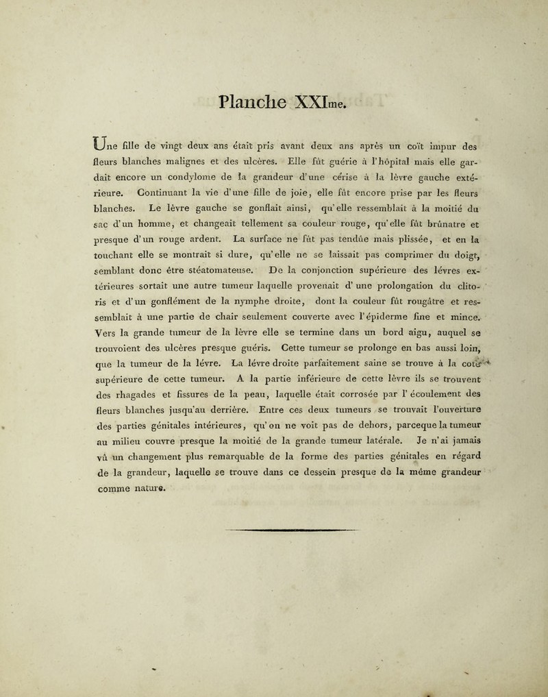 One fllle de vingt deux ans etait pris avant deux ans apres un co'it impur des fleurs blanches malignes et des ulceres. Elle fut guerie a l’hopital mais elle gar- dait encore un condylome de la grandeur d’une cerise a la levre gauche exte- rieure. Continuant la vie d’une fdle de joie, elle fut encore prise par les fleurs blanches. Le levre gauche se gonflait ainsi, qu’elle ressemblait a la moitie du sac d’un homme, et changeait tellement sa couleur rouge, qu’elle fut brunatre et presque d’un rouge ardent. La surface ne fut pas tendhe mais plissee, et en la touchant elle se montrait si dure, qu’elle ne se laissait pas comprimer du doigt, semblant done £tre steatomateuse. De la conjonction superieure des levres ex- terieures sortait une autre tumeur laquelle provenait d’ une prolongation du clito- ris et d’un gonfiement de la nymphe droite, dont la couleur fut rougatre et res- semblait a une partie de chair seulement couverte avec l’epiderme line et mince. Vers la grande tumeur de la levre elle se termine dans un Lord aigu, auquel se trouvoient des ulceres presque gueris. Cette tumeur se prolonge en bas aussi loin, que la tumeur de la levre. La levre droite parfaitement saine se trouve a la cottf superieure de cette tumeur. A la partie inferieure de cette l£vre ils se trouvent des rhagades et fissures de la peau, laquelle etait corrosee par 1’ecoulement des fleurs blanches jusqu’au derriere. Entre ces deux tumeurs se trouvait l’ouverture des parties genitales interieures, qu’on ne voit pas de dehors, pareeque la tumeur au milieu couvre presque la moiti4 de la grande tumeur laterale. Je n’ai jamais vu un changement plus remarquable de la forme des parties genitales en regard de la grandeur, laquelle se trouve dans ce dessein presque de la mdme grandeur comme nature.