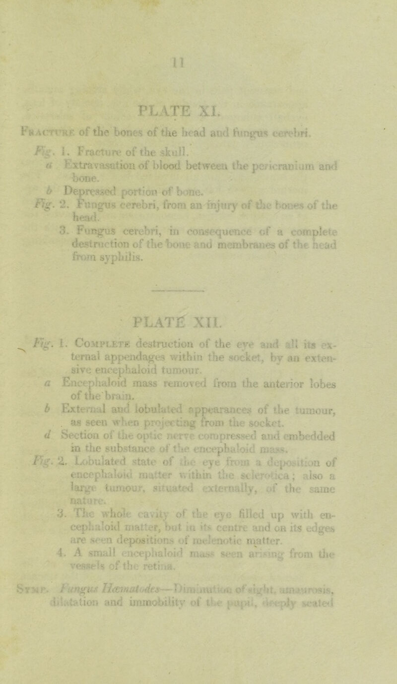 PLATE XL hw of the bores of the head and fungus ene-hri. F-g. 1. Fracture of the skull. r> ’• xtrav rs:;tion of blood bet wet:.u the ]. icraa im and bone. b I>ep reased portion o4' b me. Fig. 2. Fungus cerebri, from an injury of the* f -o; - i of the head. 3. • Fungus cerebri, in consequence of a complete desire, tion of the bo 1 -’Hi m :mbr?mes of *’ > . t>d from syphilis. PLATE XII. Ft”', i. Complete destruction of the e1- a .• ( u its ternal appendages within the socket, by an exten- sive encephaloid tumour. a Eneephaloid mass removed from the anterior lobes ofthe bra n. b Extvn d atsd lobule cd eppearam os of the tumour, . as been m Act. a Section of the onric: me- compressed and embedded in the substance uf i • • < ocepbr. I d. :. • an - no. . v • e , .... ..?> uf eacepltaloio mailer within the sclerotica; also a largi tumour, situated xtentaily, f the same nature. 3. Che whoh cant; of t1 e t o filled up with en- ceplm’oid mat nr, hut u centre and units edges • -.re n deposition:- •(' nu r,.noti< mutter 4. A small ncephaloib huh- sc n ar -mg' from the vessf- h of the ret.i .a. Svxr. / \oyru.': llmnut dt.s - 1 urn.aid; >n e4 righi :«:.uv >*js tdatatiou and immobility of i t : ; • ■ dy seated